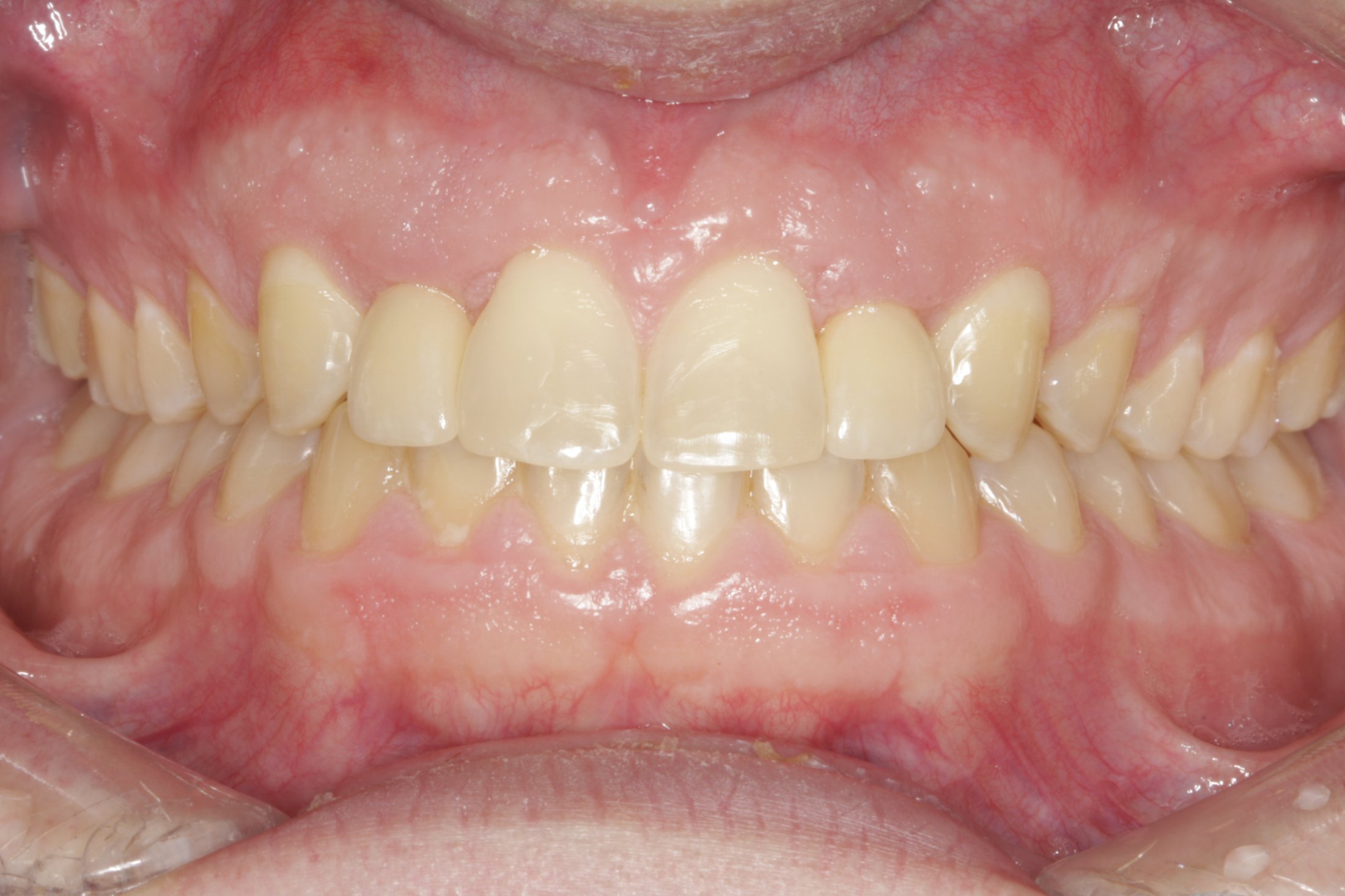 Esthetic Crown Lengthening case study