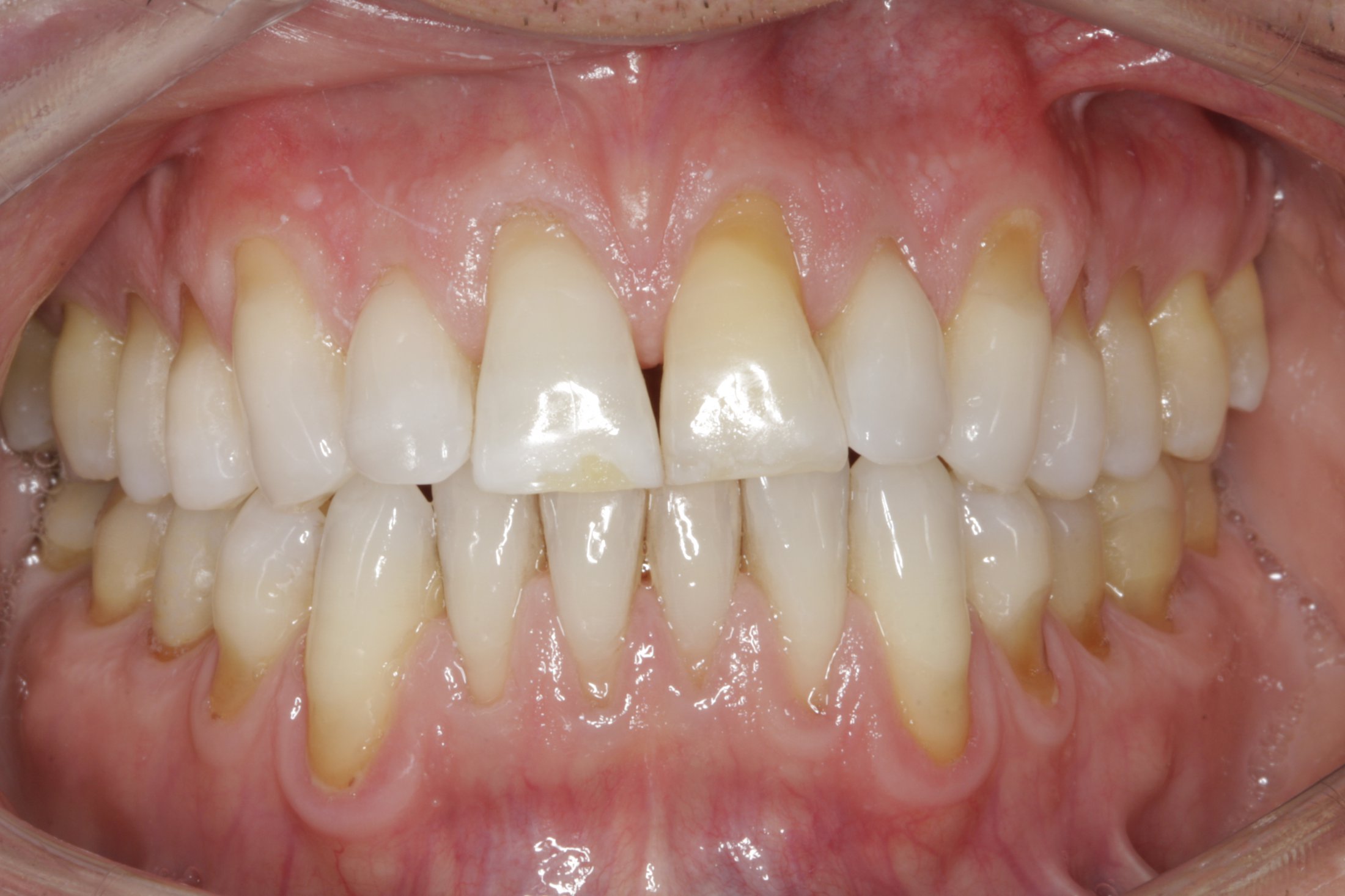 Allograft case study