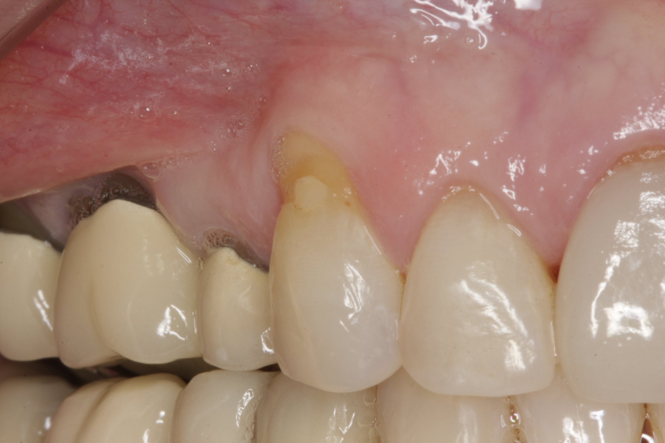 Allograft case study