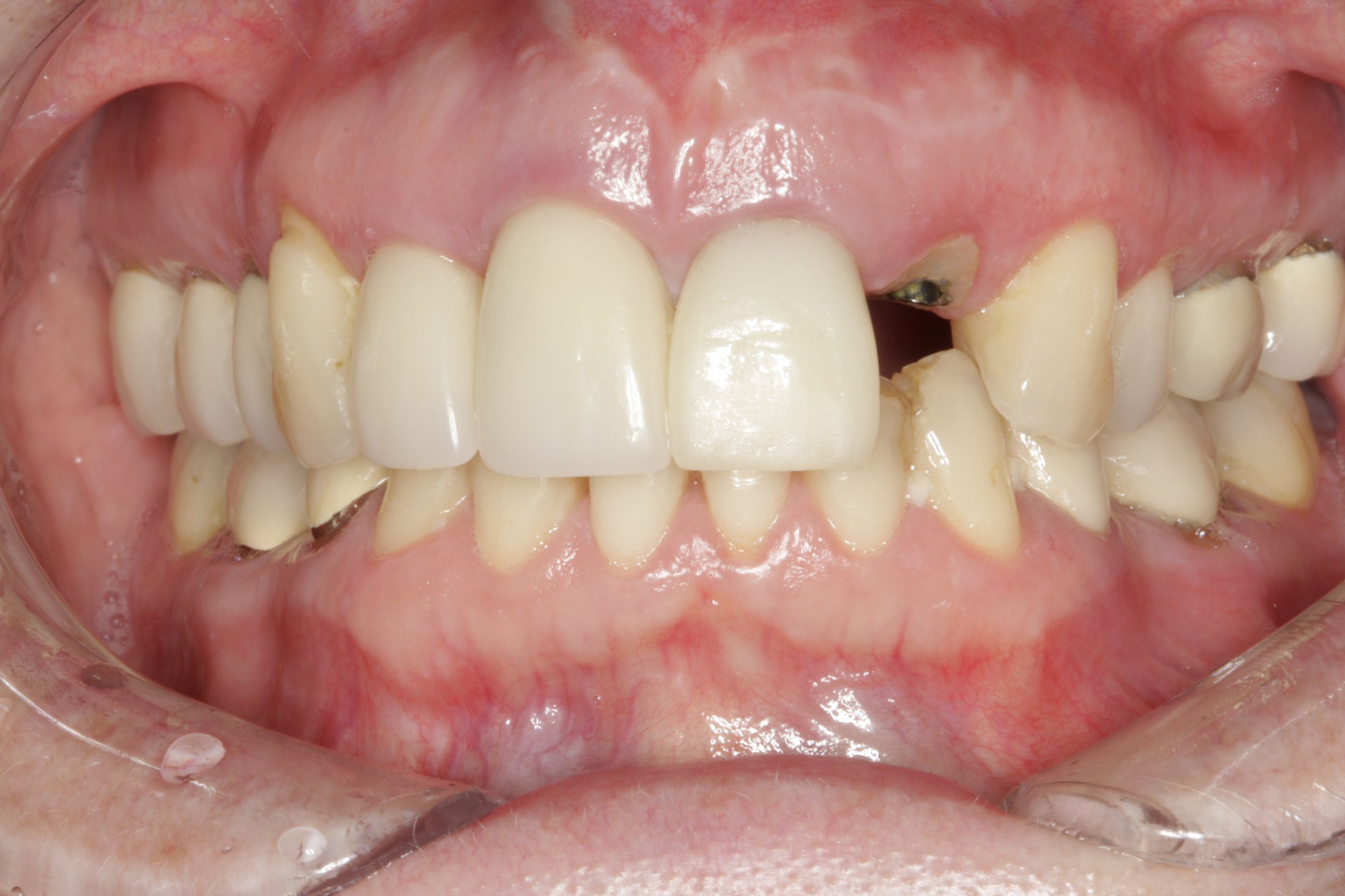 Dental Implants case study