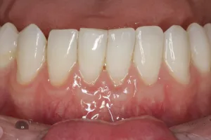 Connective Tissue Graft case study