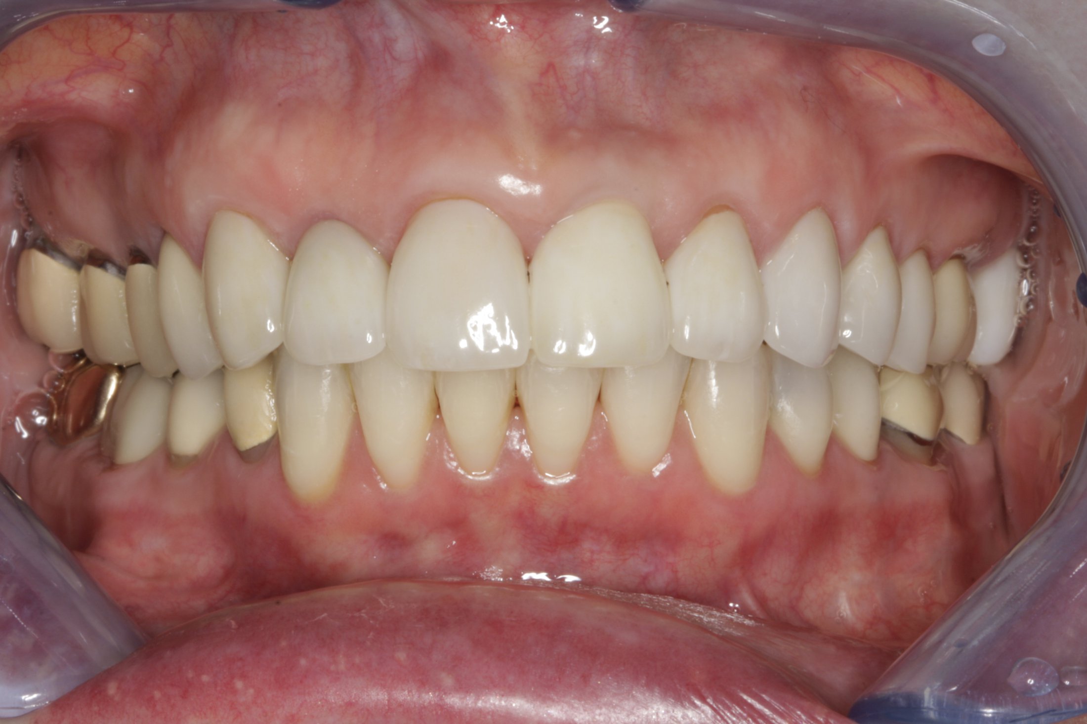Dental Implants case study