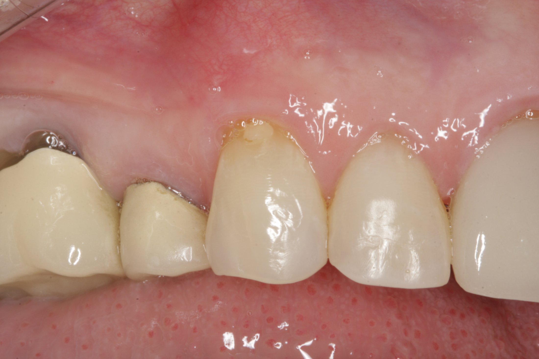 Allograft case study