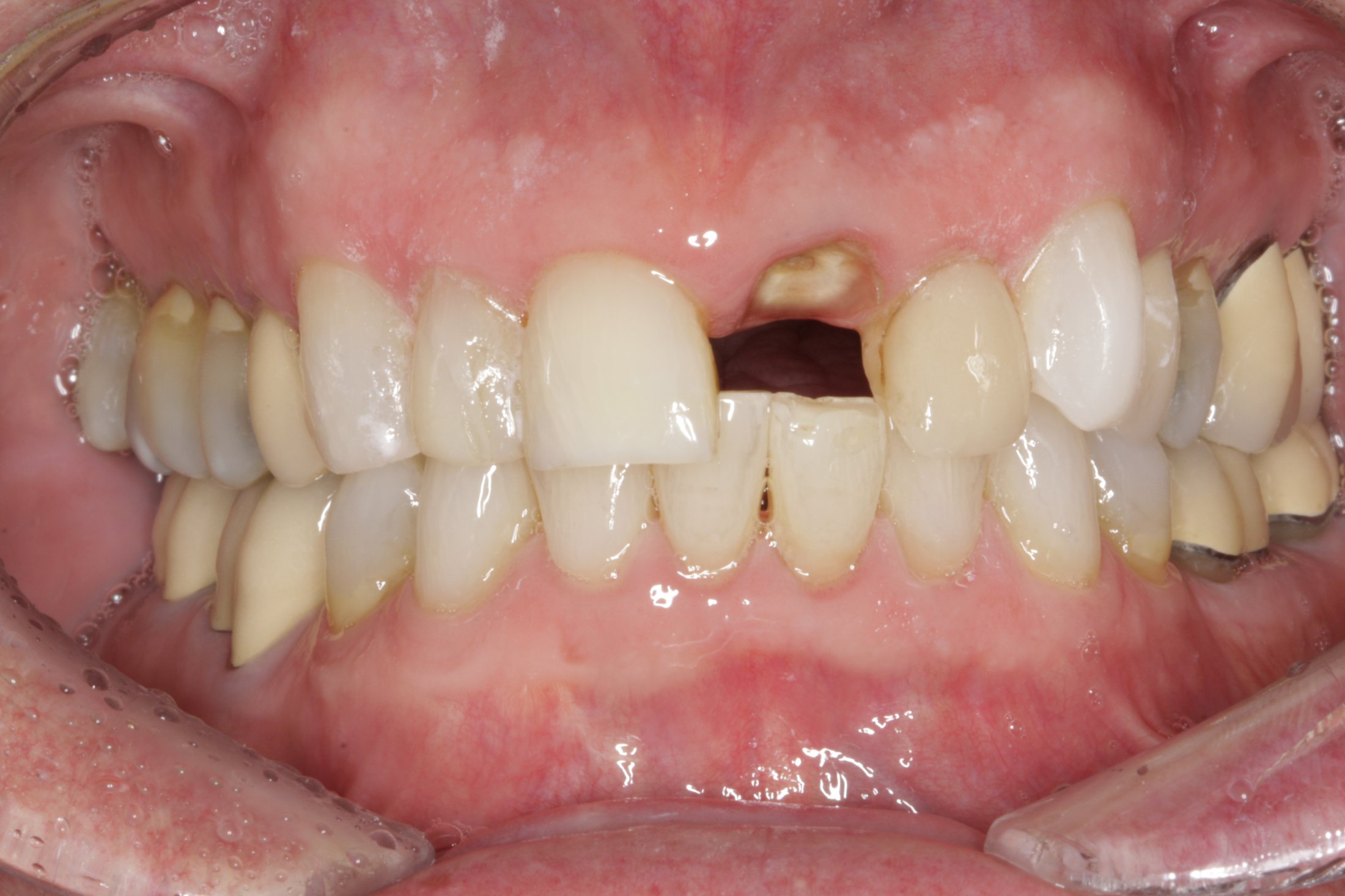Dental Implants case study