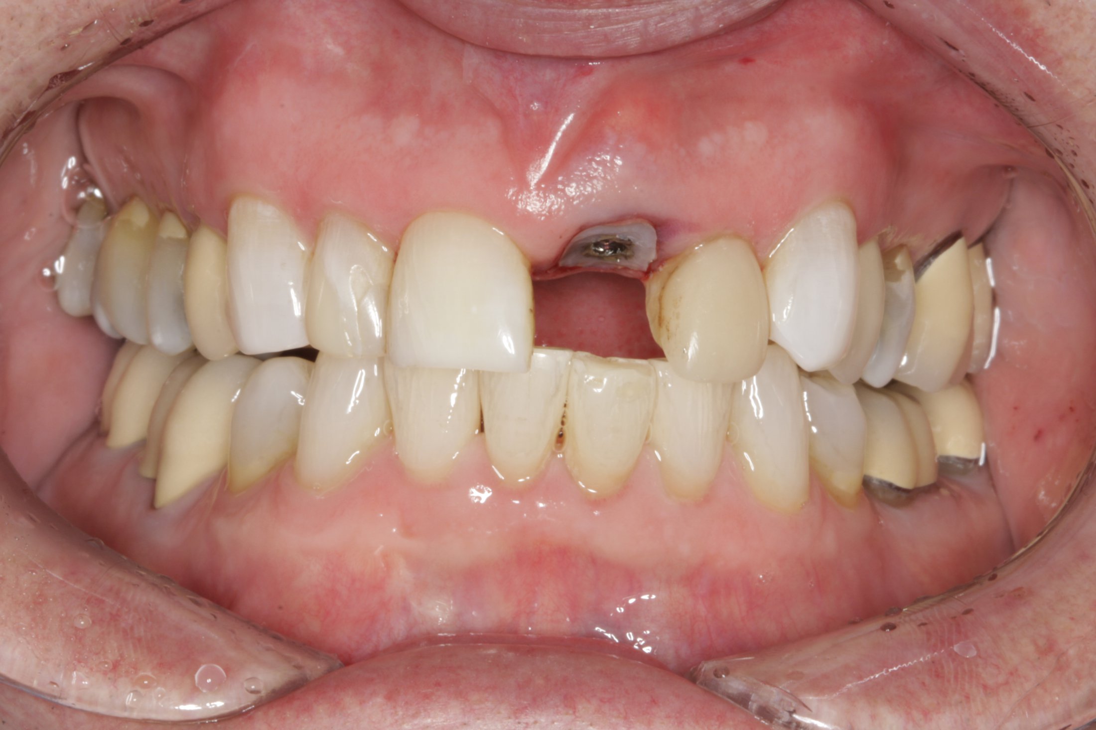 Dental Implants case study