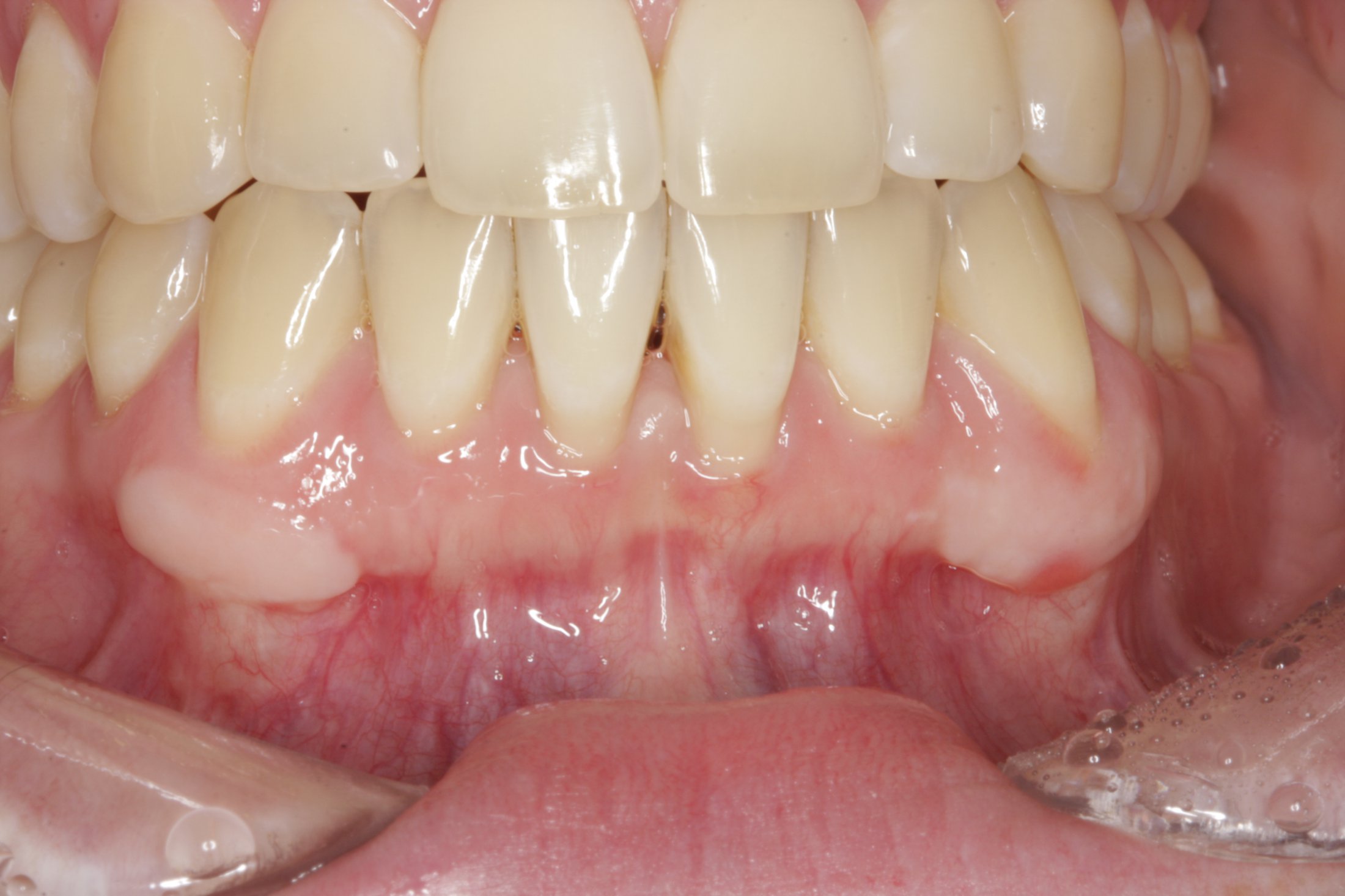 Free Gingival Graft case study