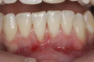 Connective Tissue Graft case study