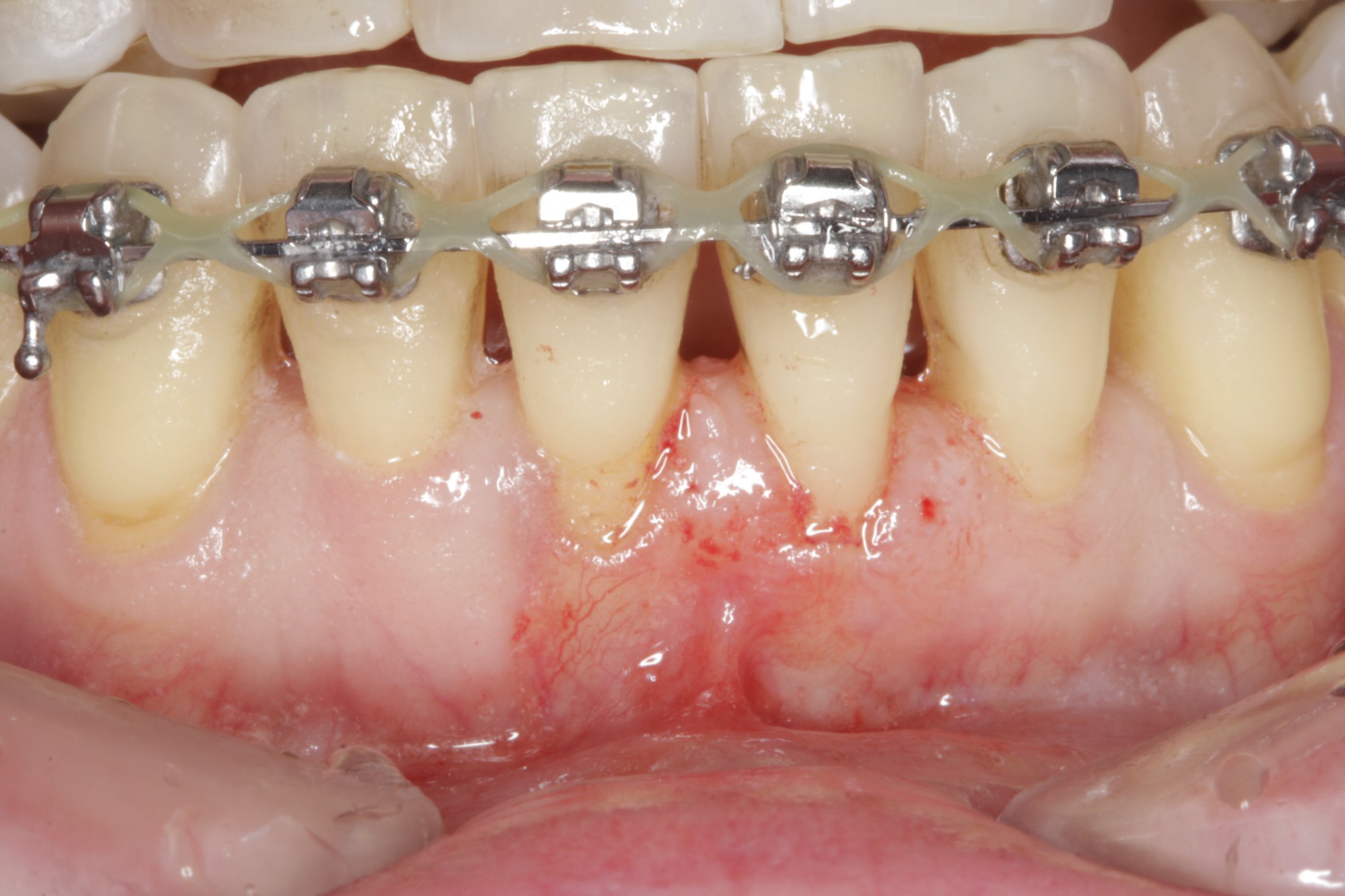Free Gingival Graft case study