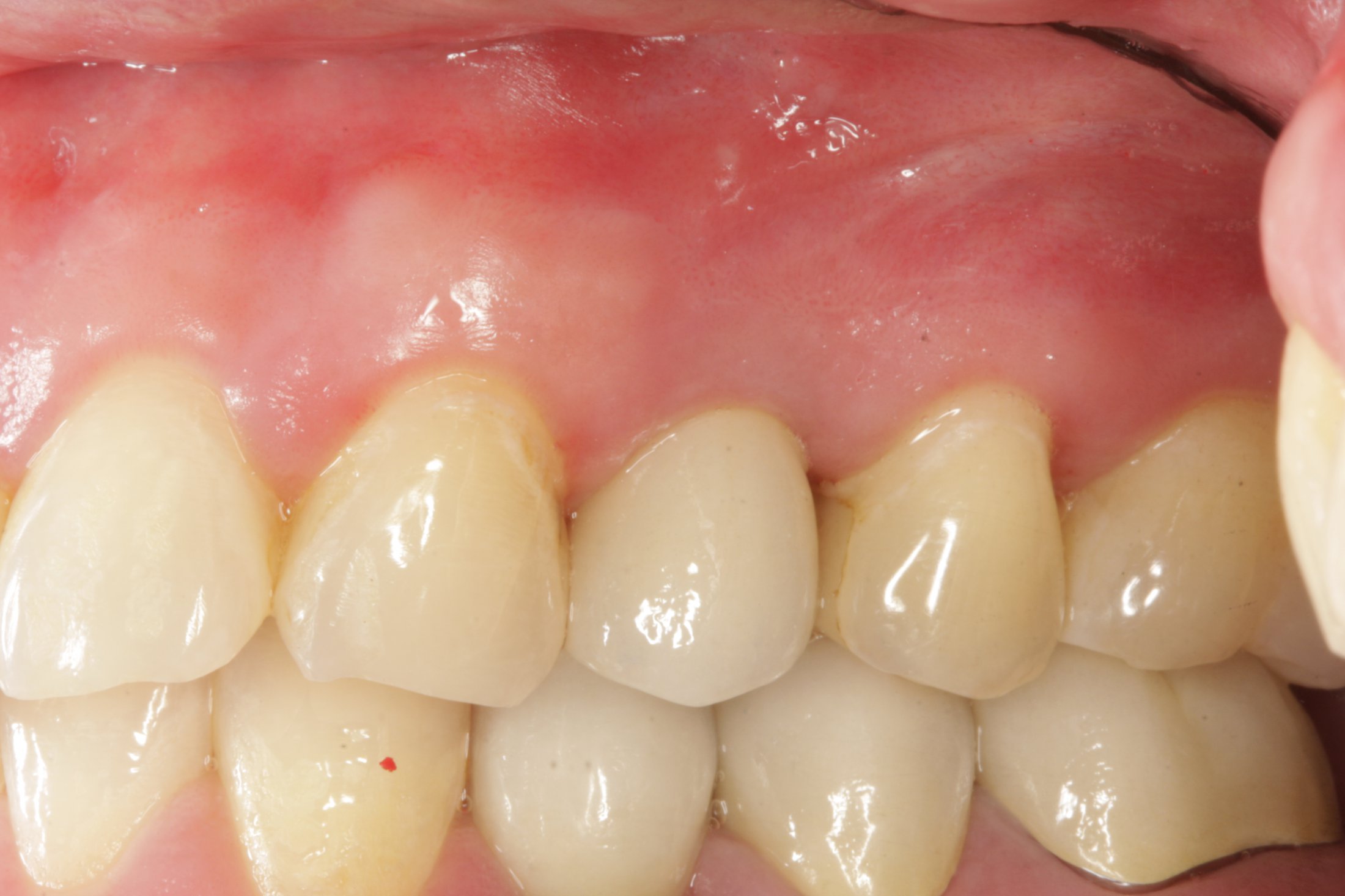Dental Implants case study