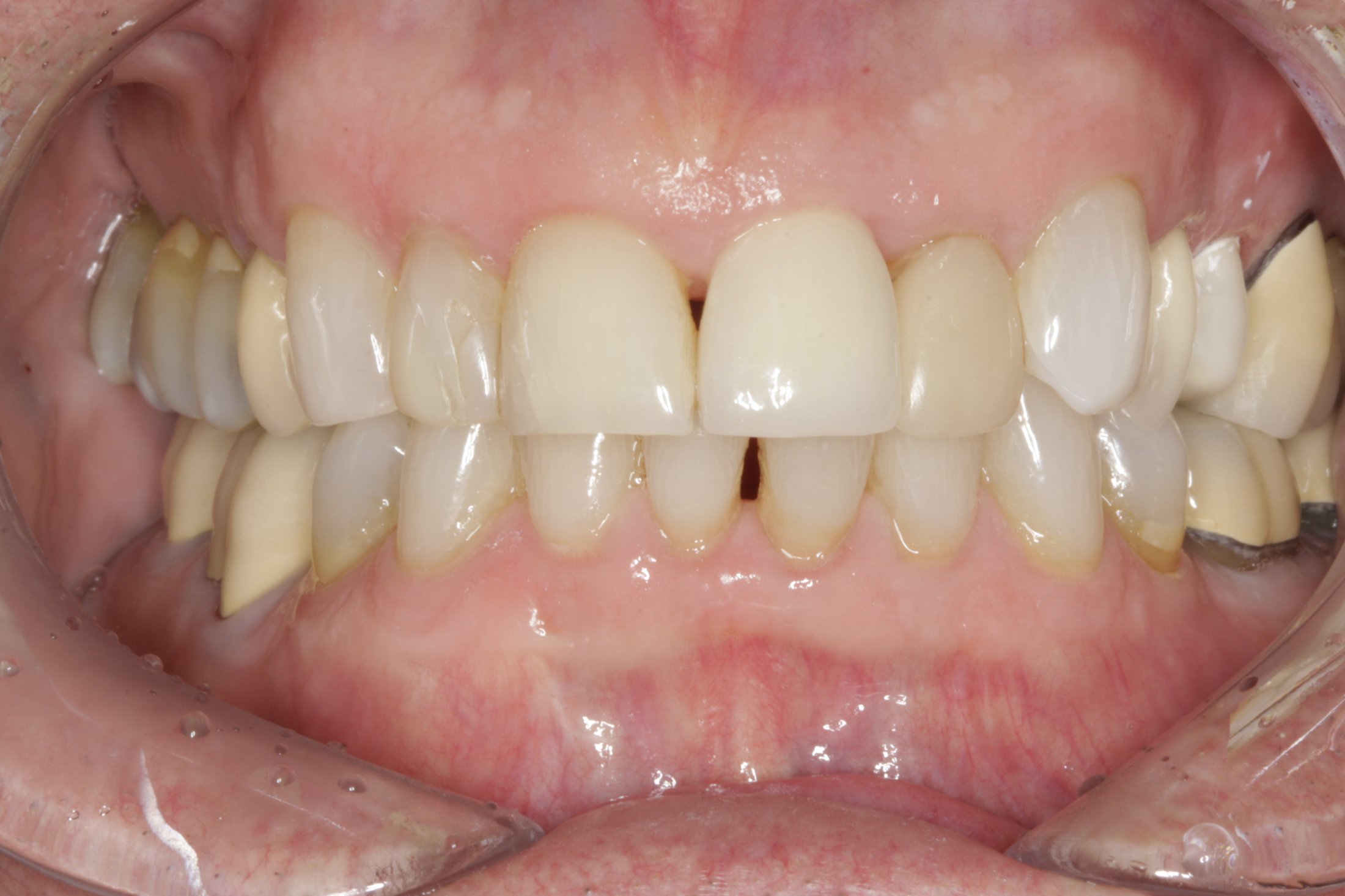 Dental Implants case study