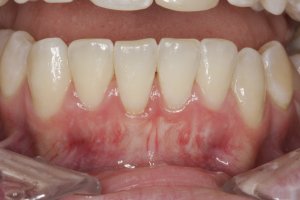 Connective Tissue Graft case study