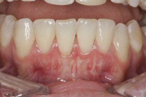 Connective Tissue Graft case study