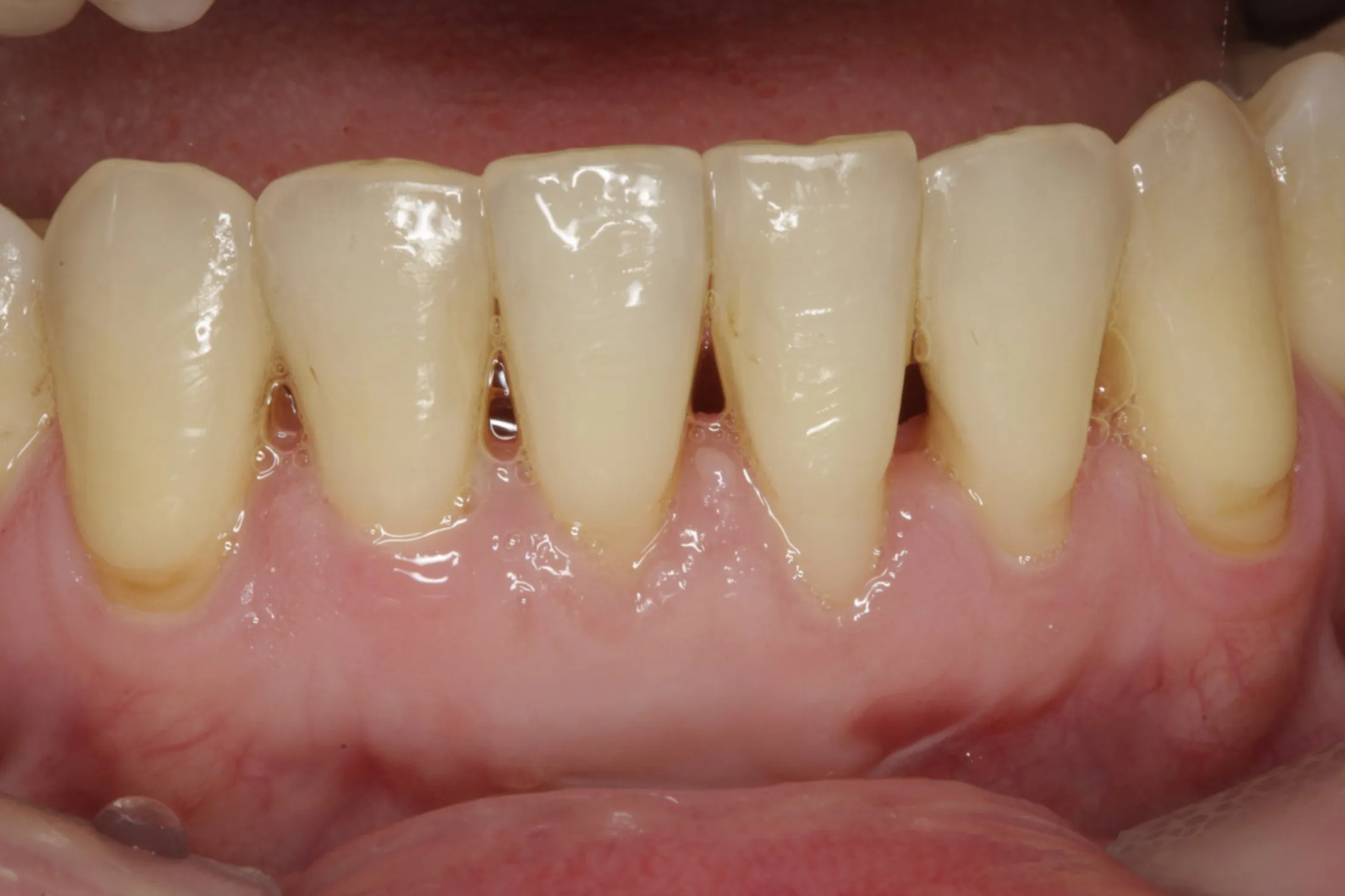 Free Gingival Graft case study