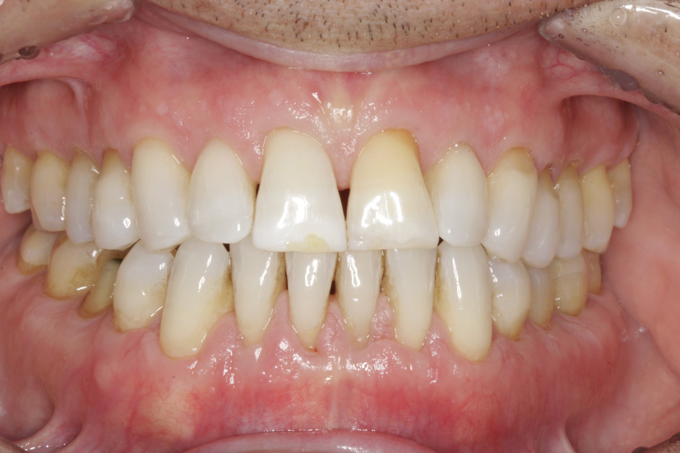 Allograft case study