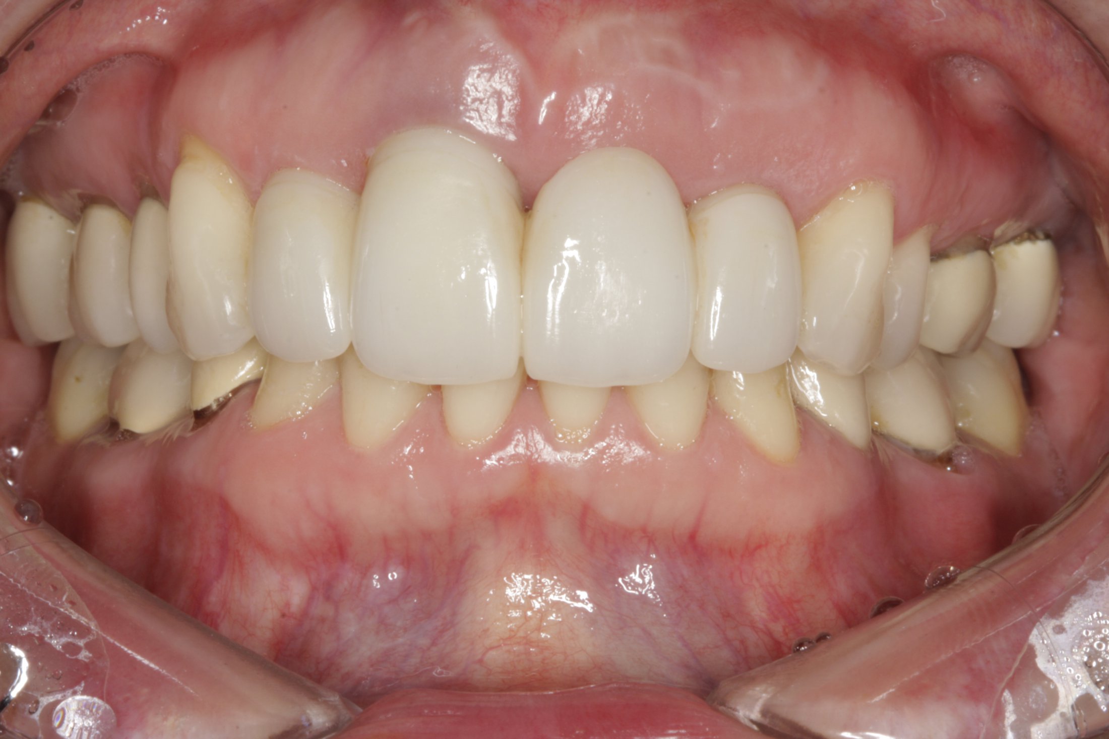 Dental Implants case study
