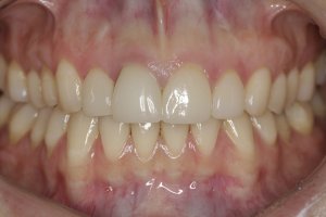 Dental Implants case study