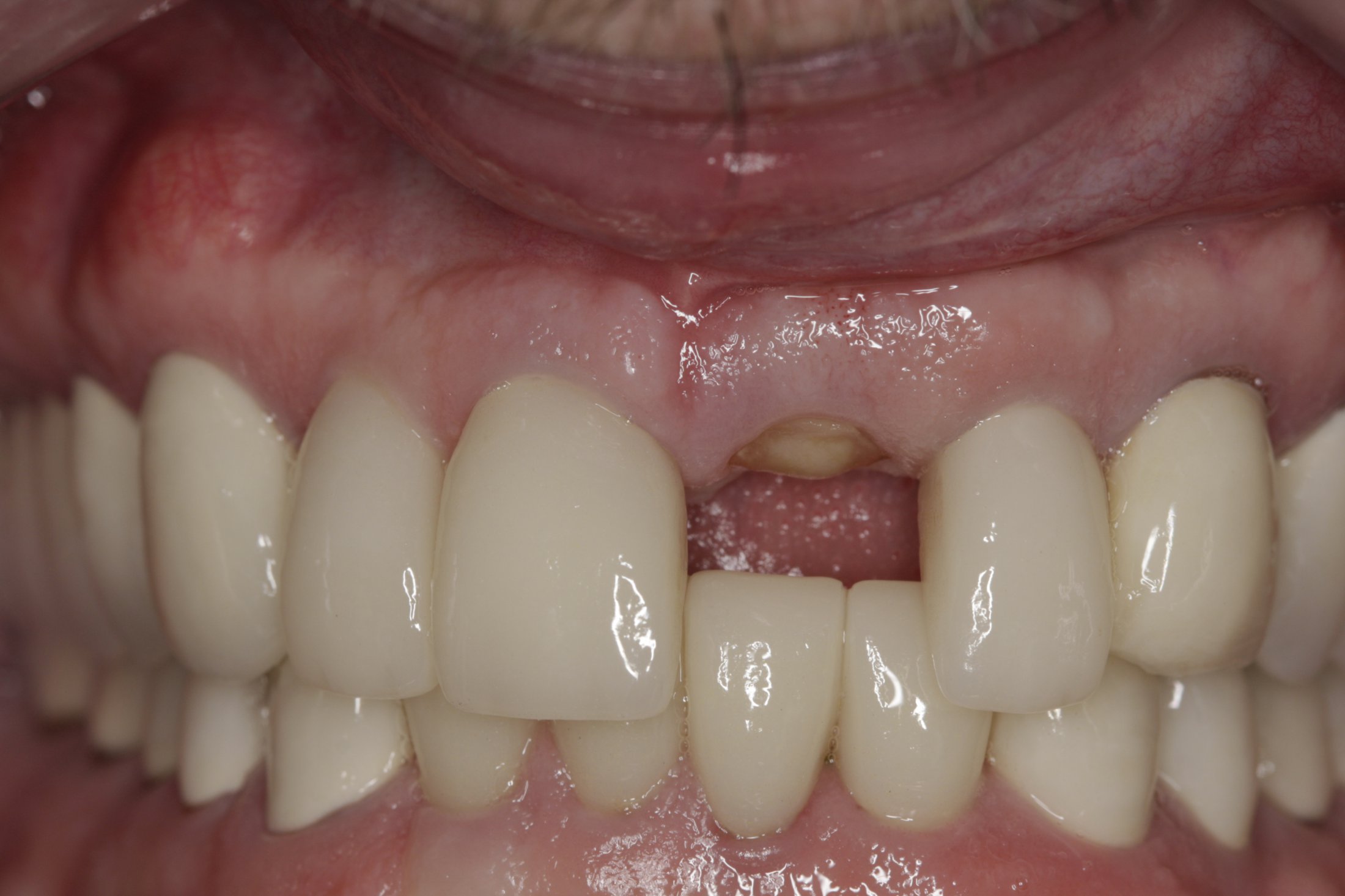 Dental Implants case study