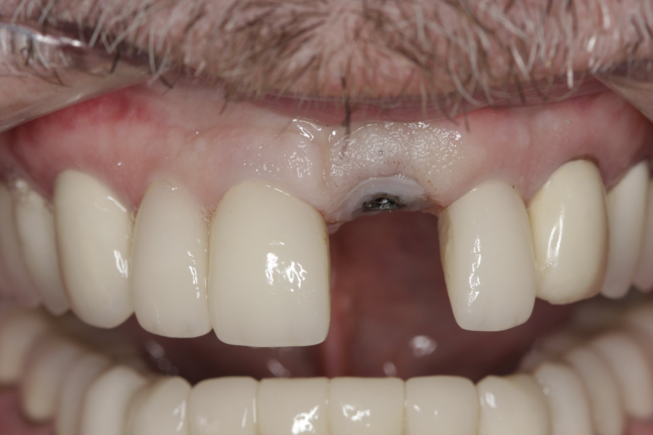 Dental Implants case study