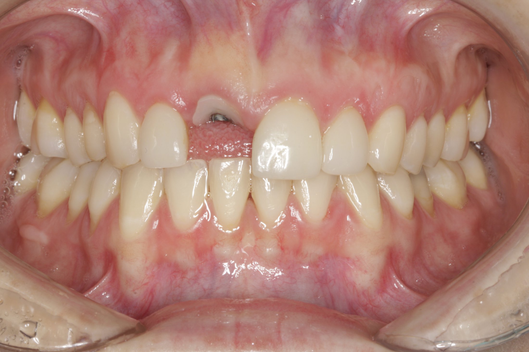 Dental Implants case study