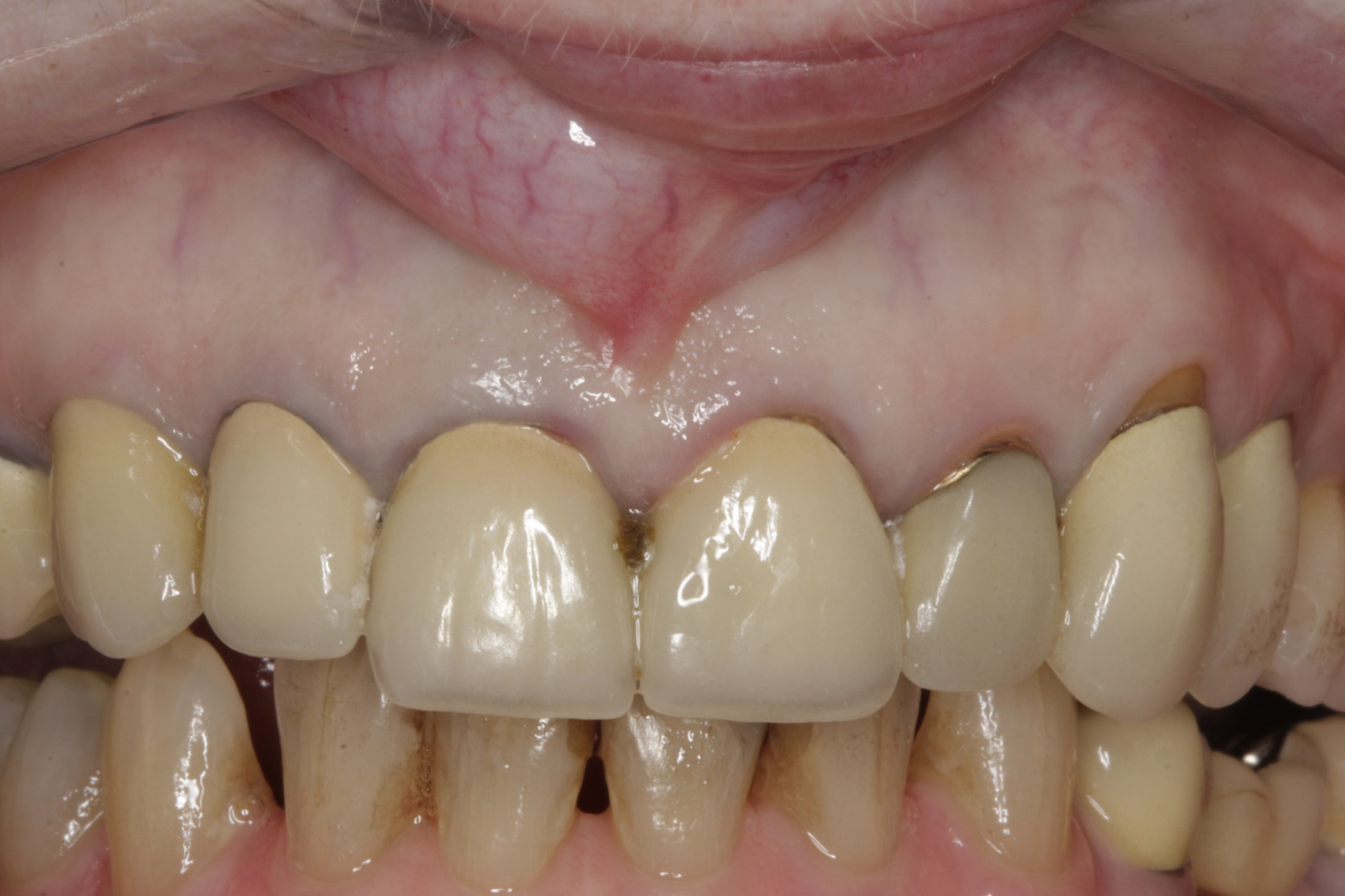 Dental Implants case study