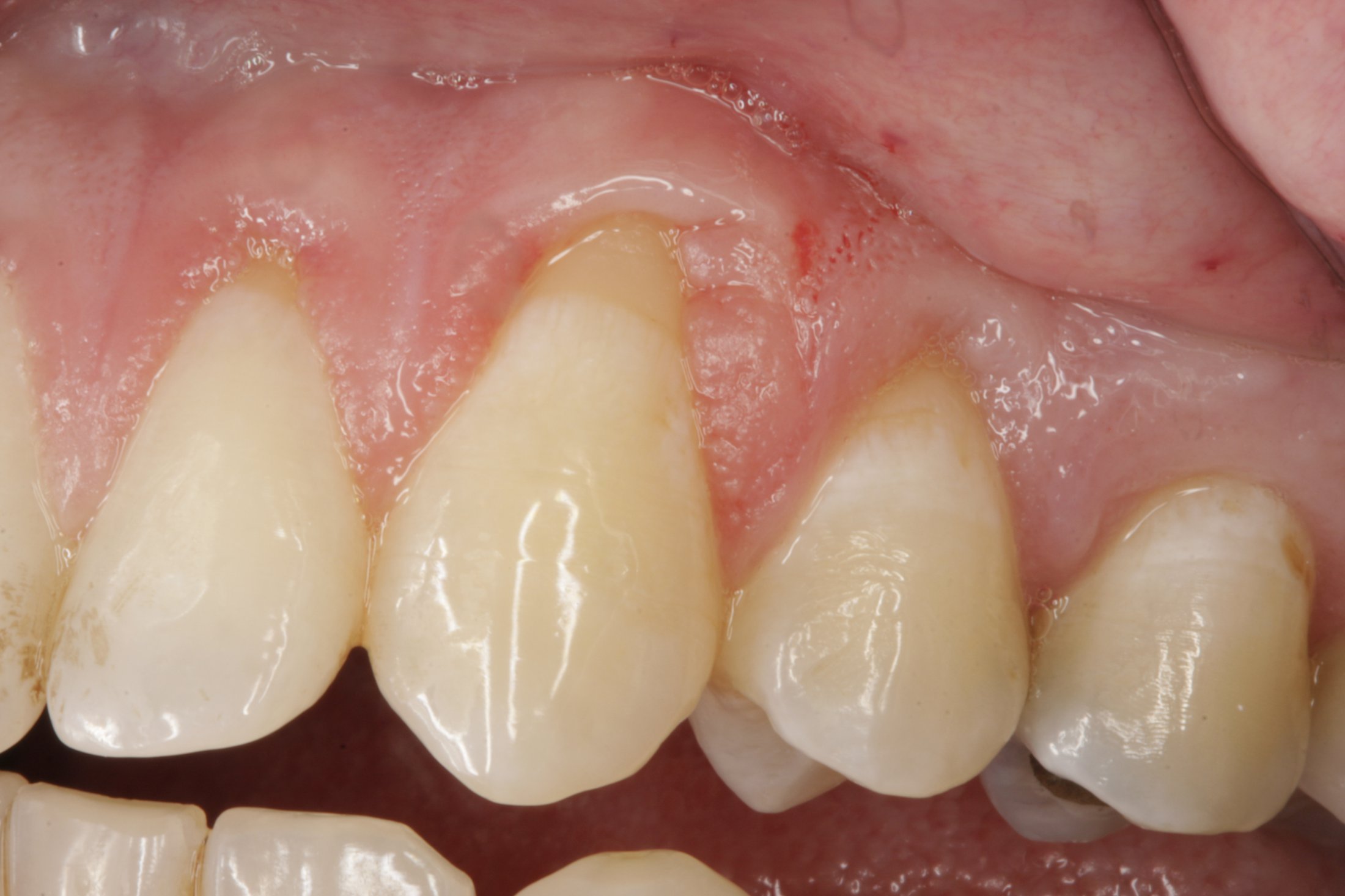 Allograft case study