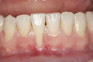 Connective Tissue Graft case study