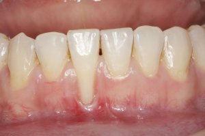 Connective Tissue Graft case study