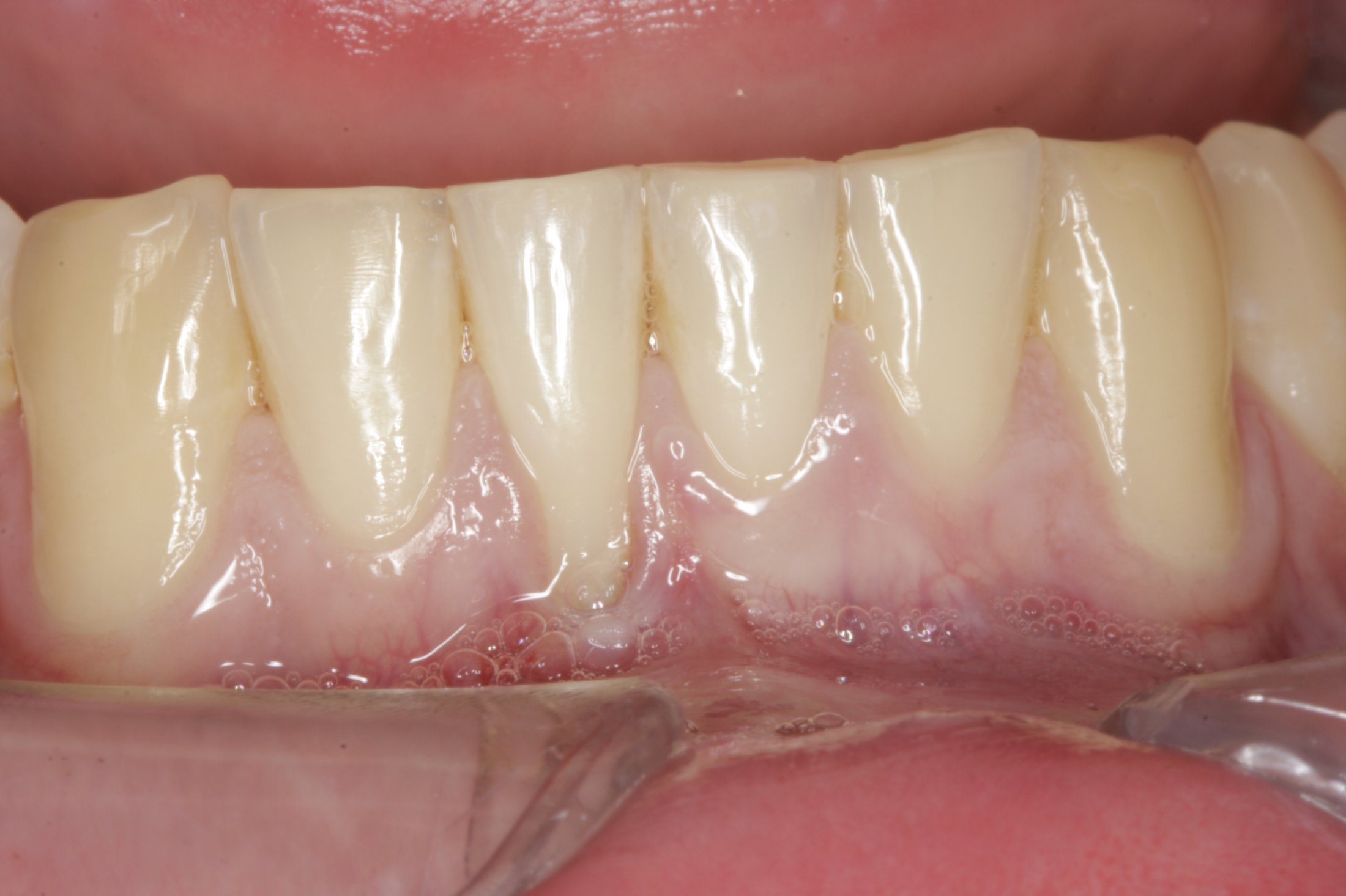 Connective Tissue Graft case study