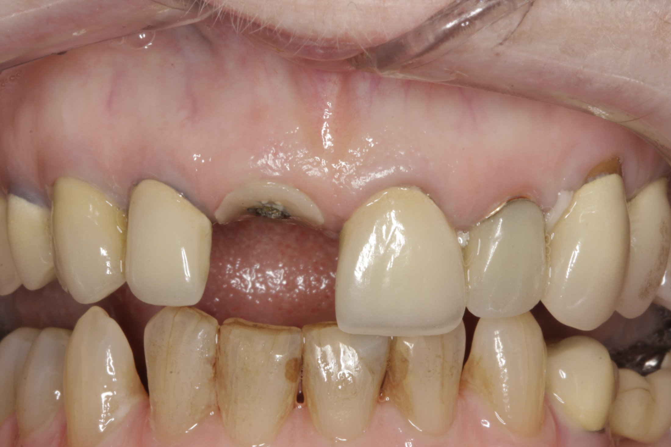 Dental Implants case study