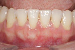 Connective Tissue Graft case study