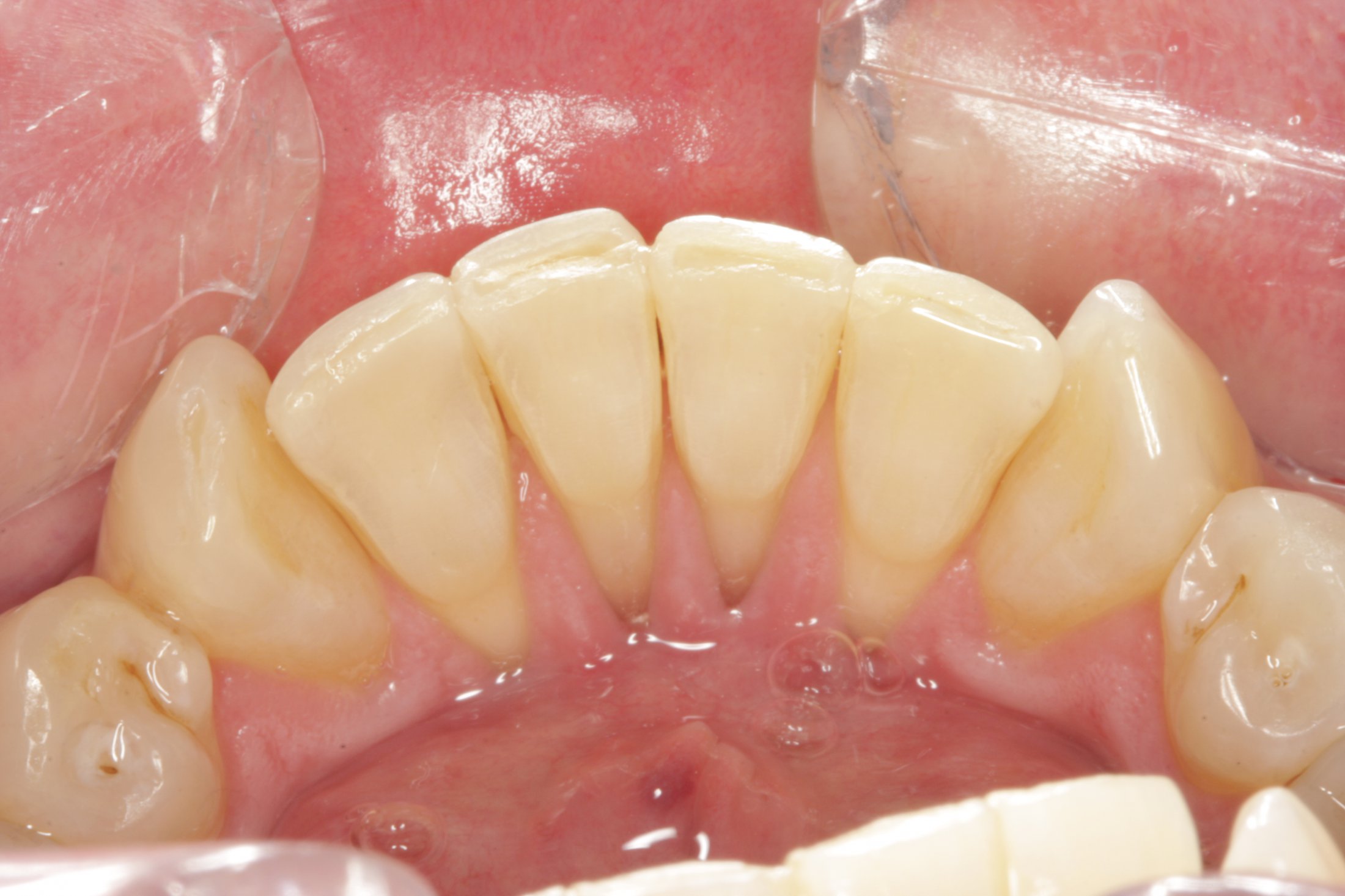 Free Gingival Graft case study
