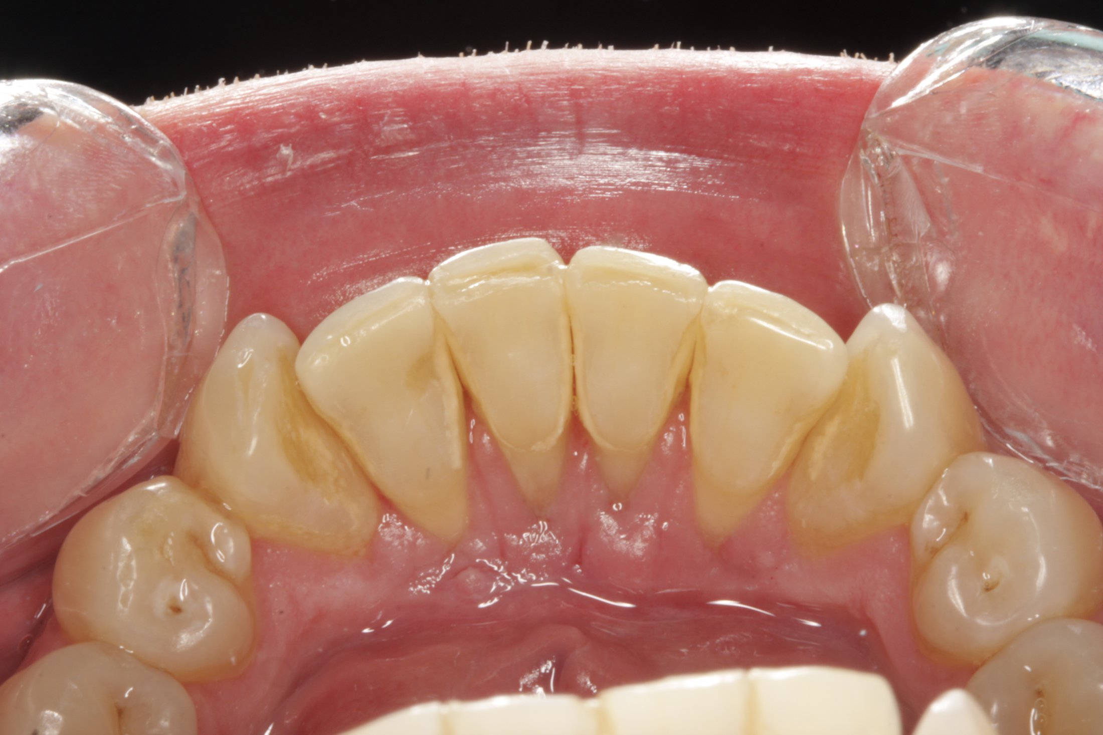 Free Gingival Graft case study