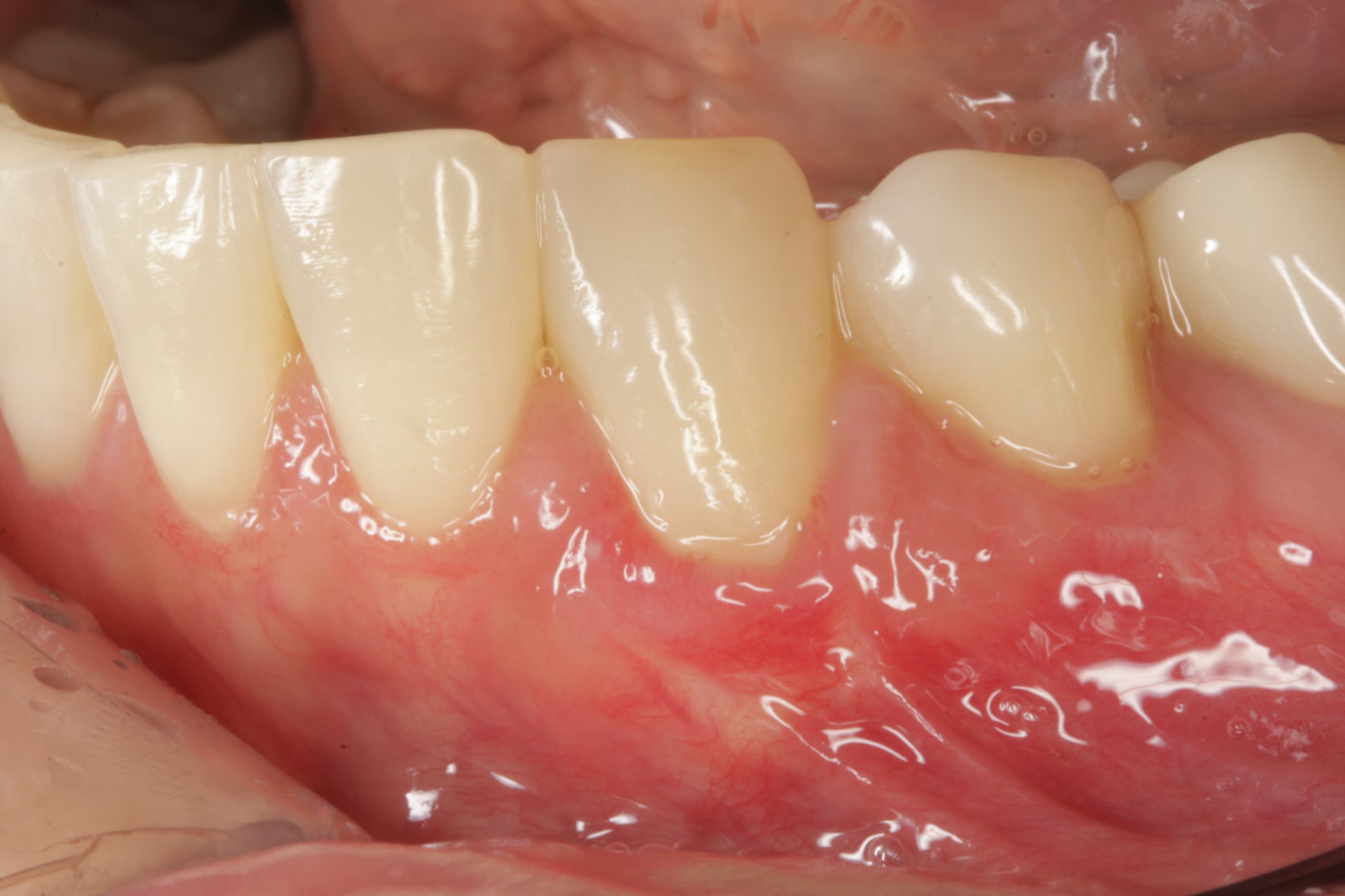 Allograft case study