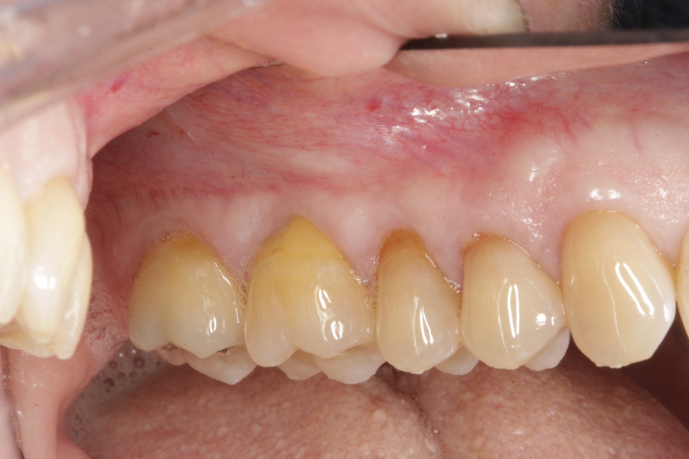 Connective Tissue Graft case study