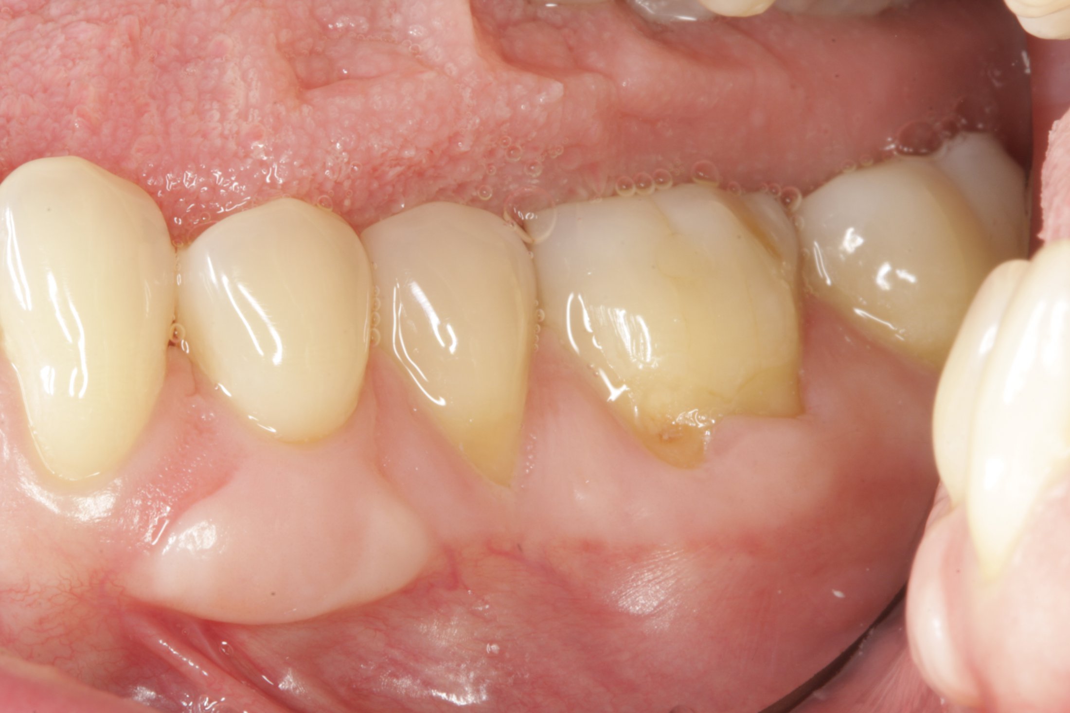 Allograft case study