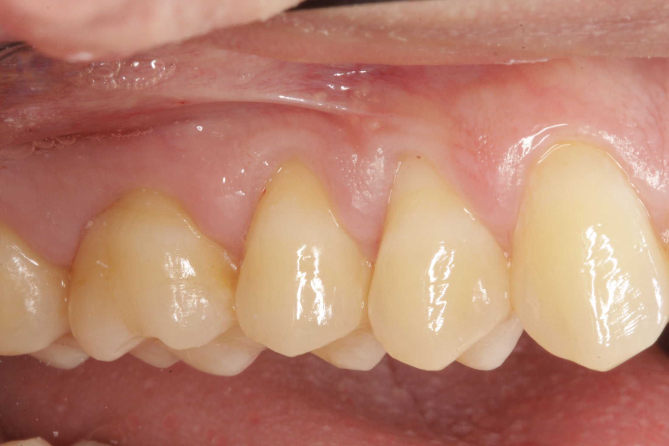 Allograft case study