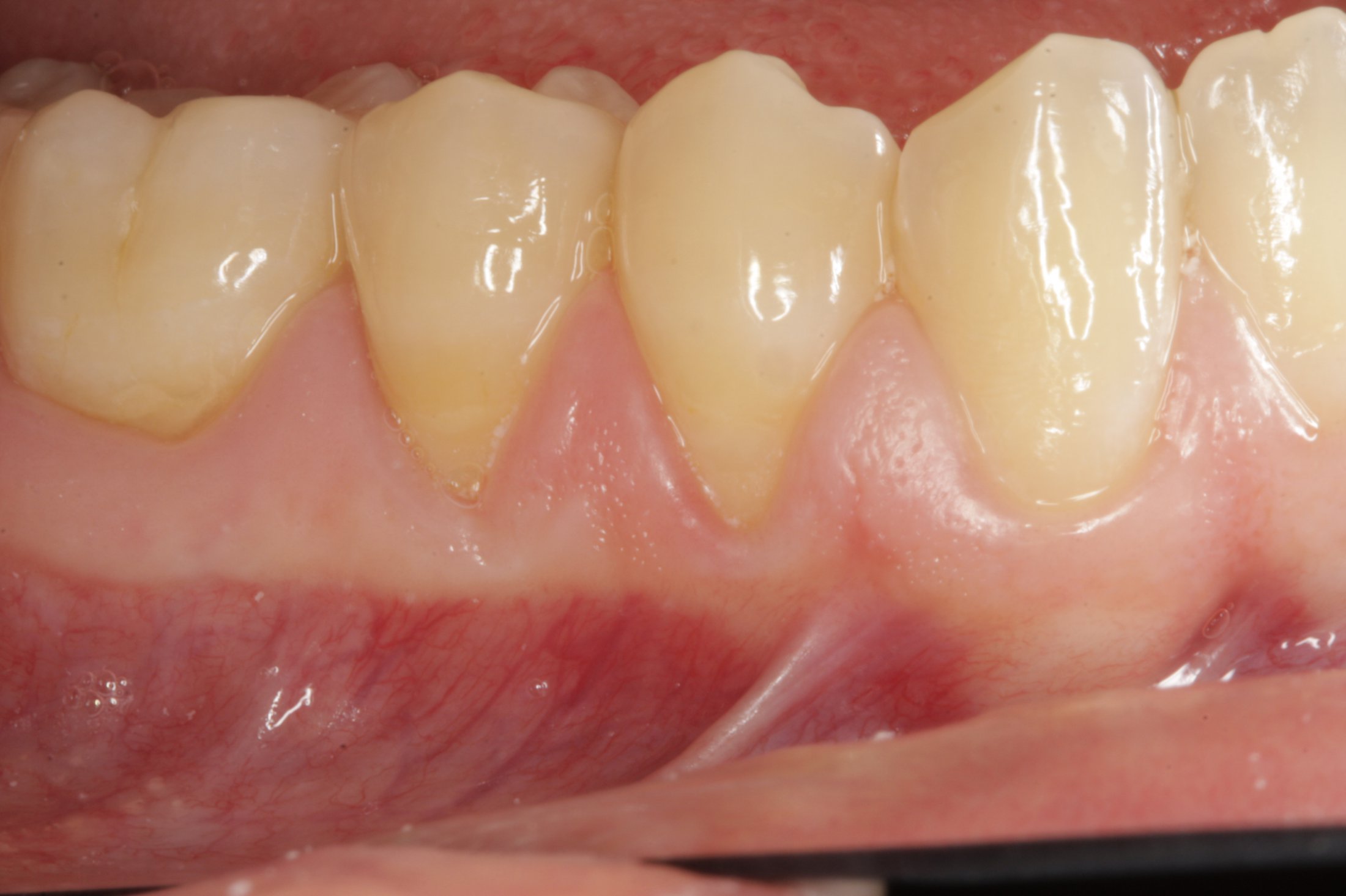 Allograft case study