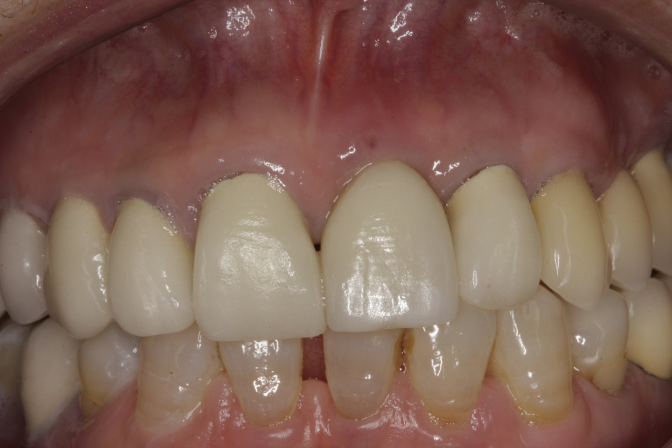 Dental Implants case study
