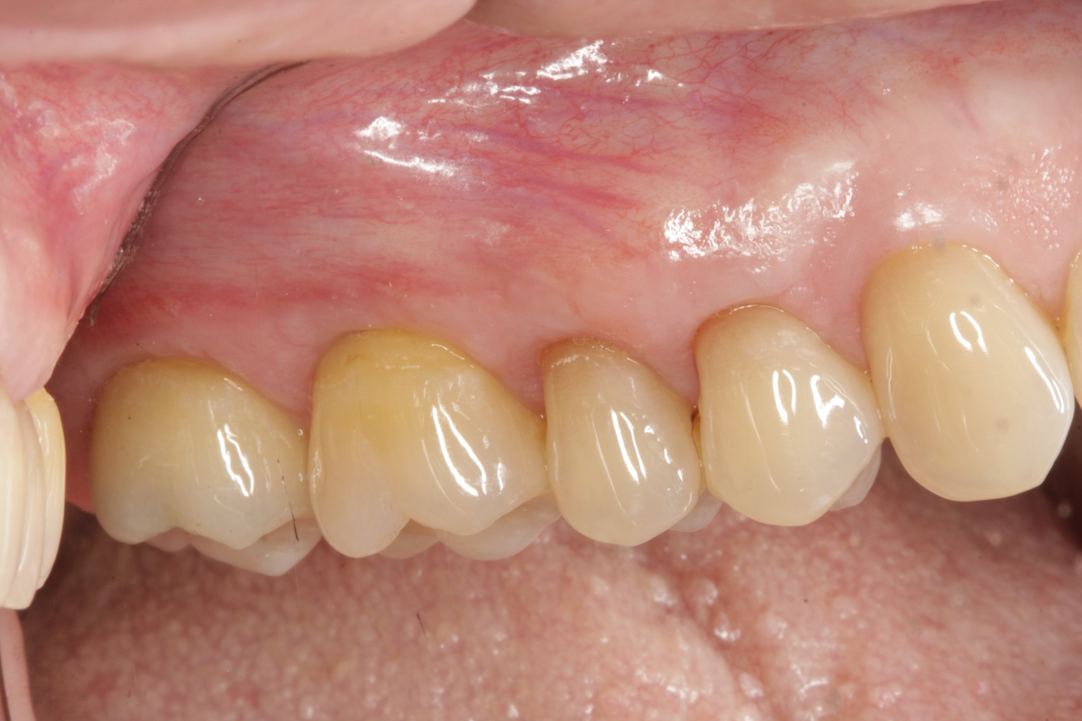 Connective Tissue Graft case study