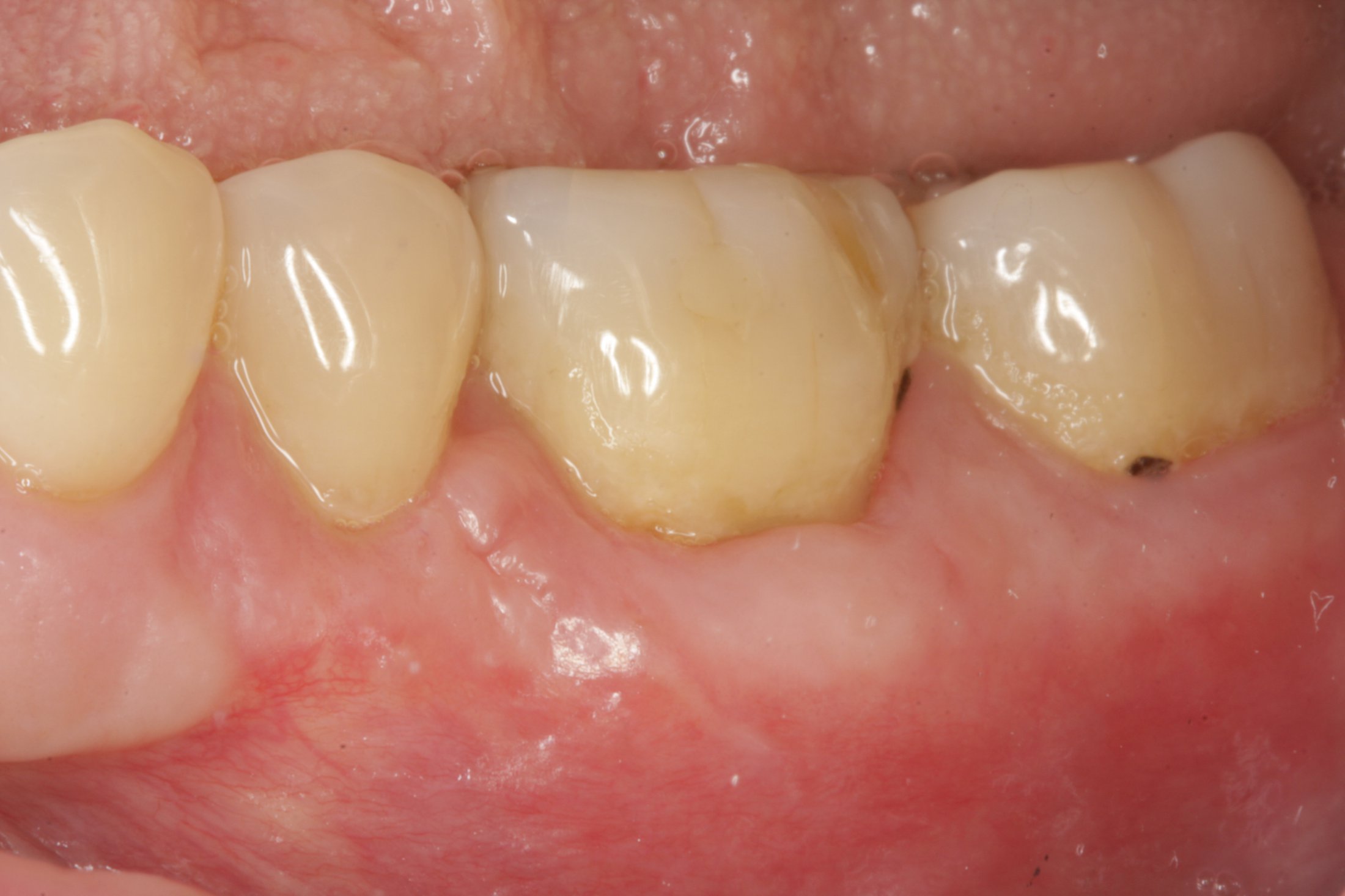 Allograft case study