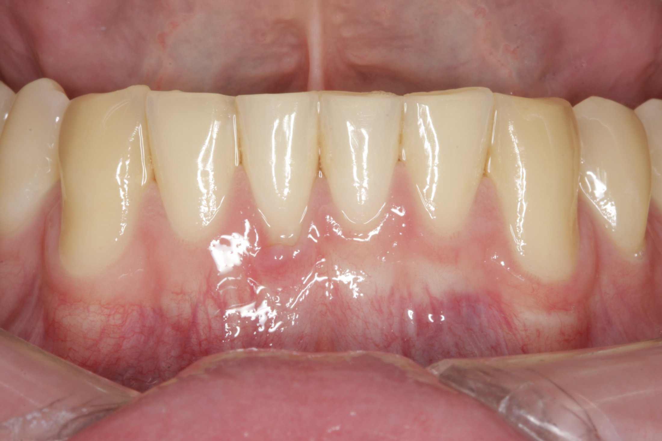 Connective Tissue Graft case study