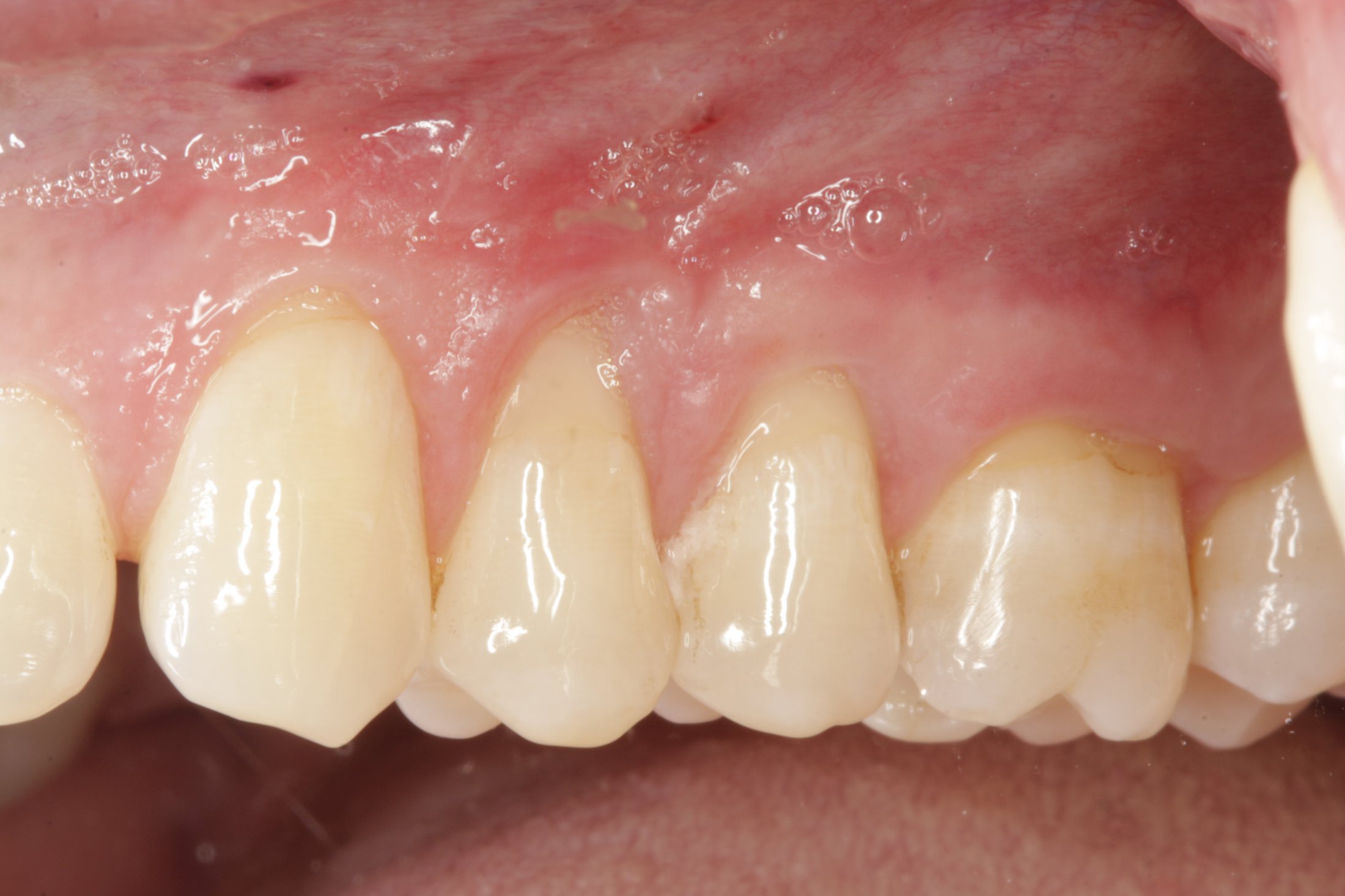 Allograft case study