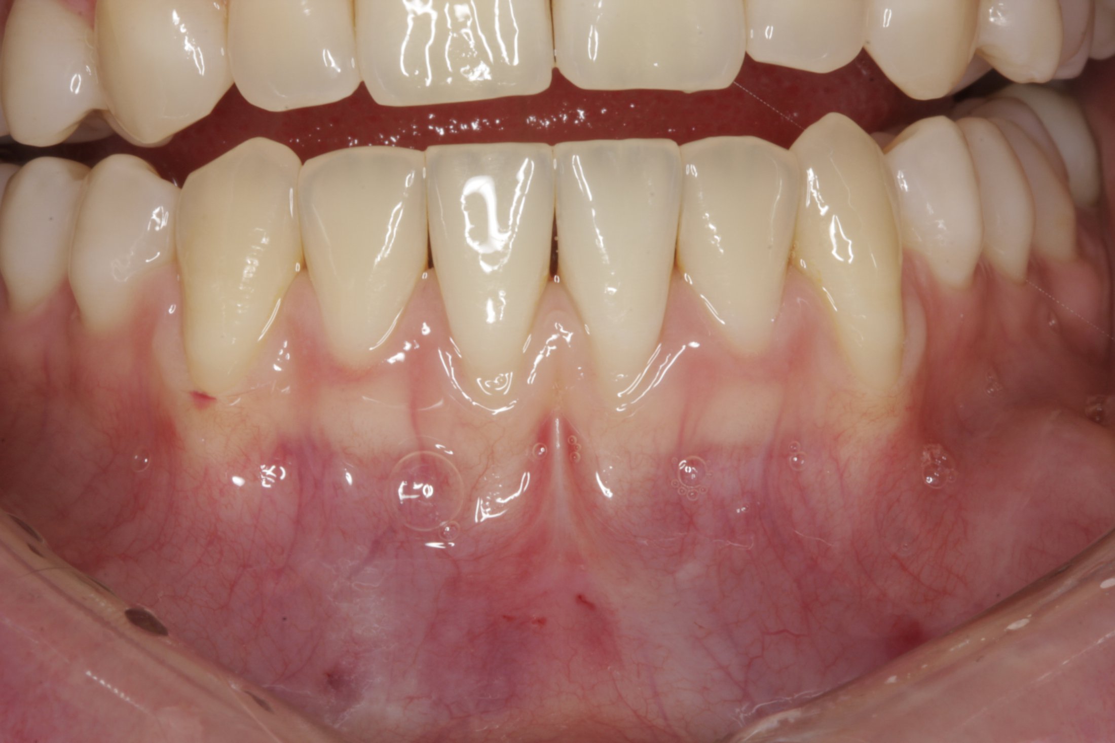 Connective Tissue Graft case study