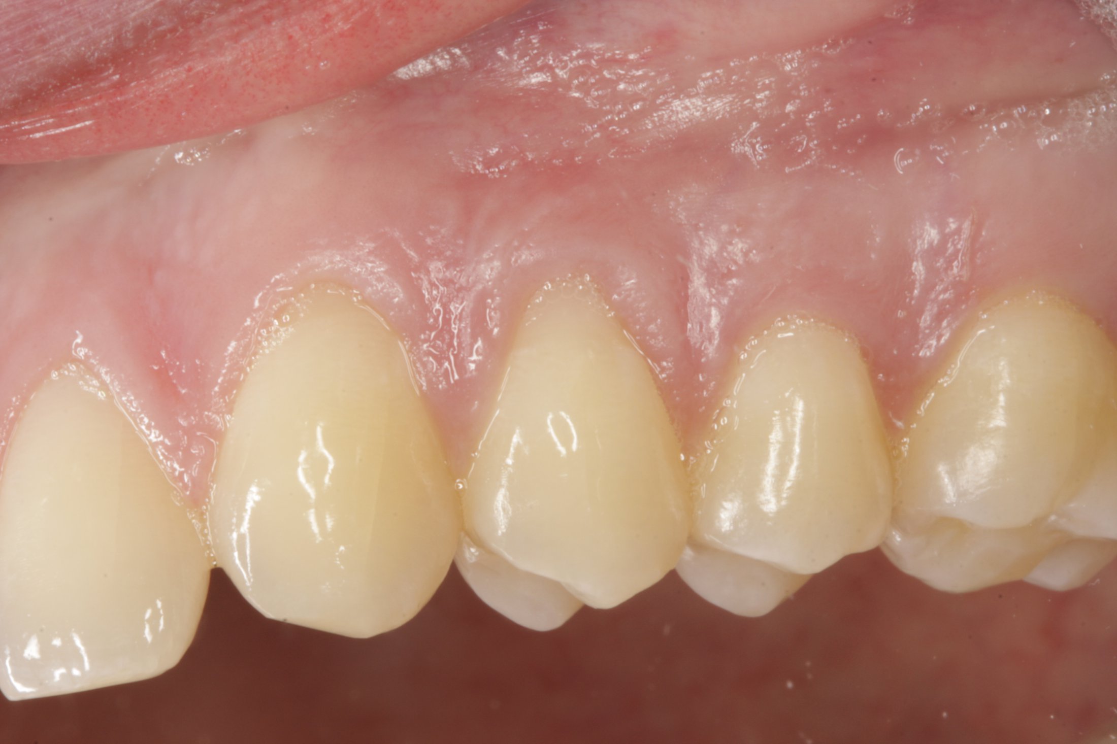 Connective Tissue Graft case study