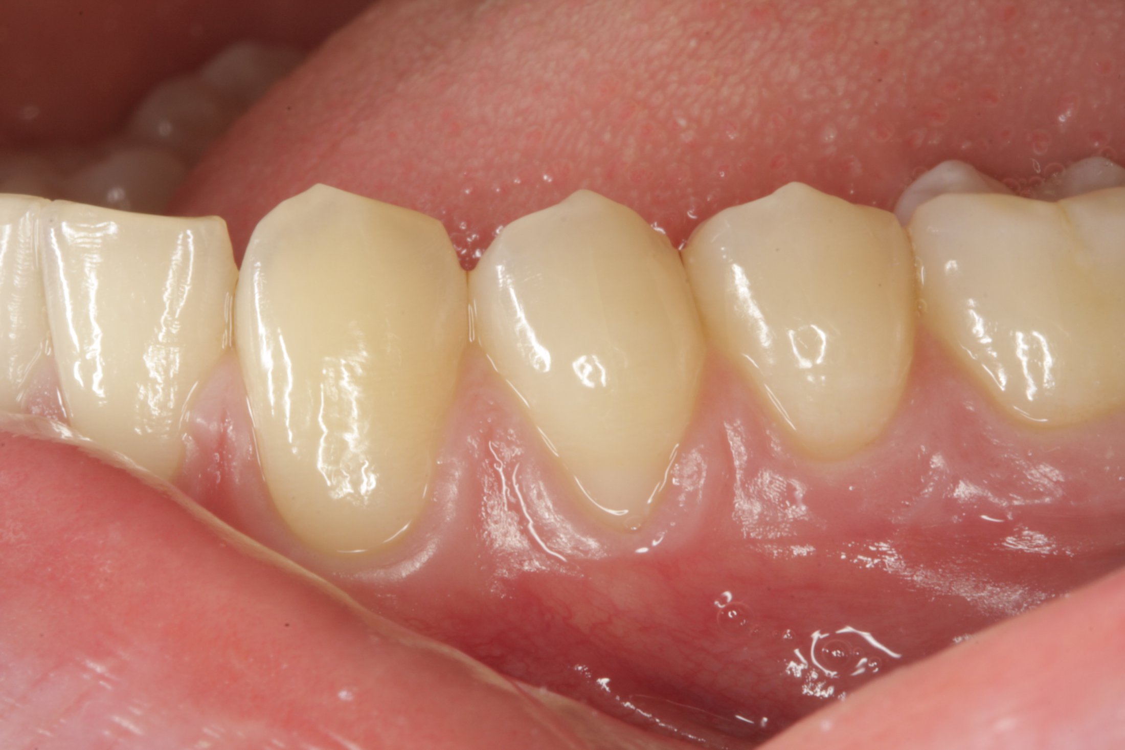 Connective Tissue Graft case study