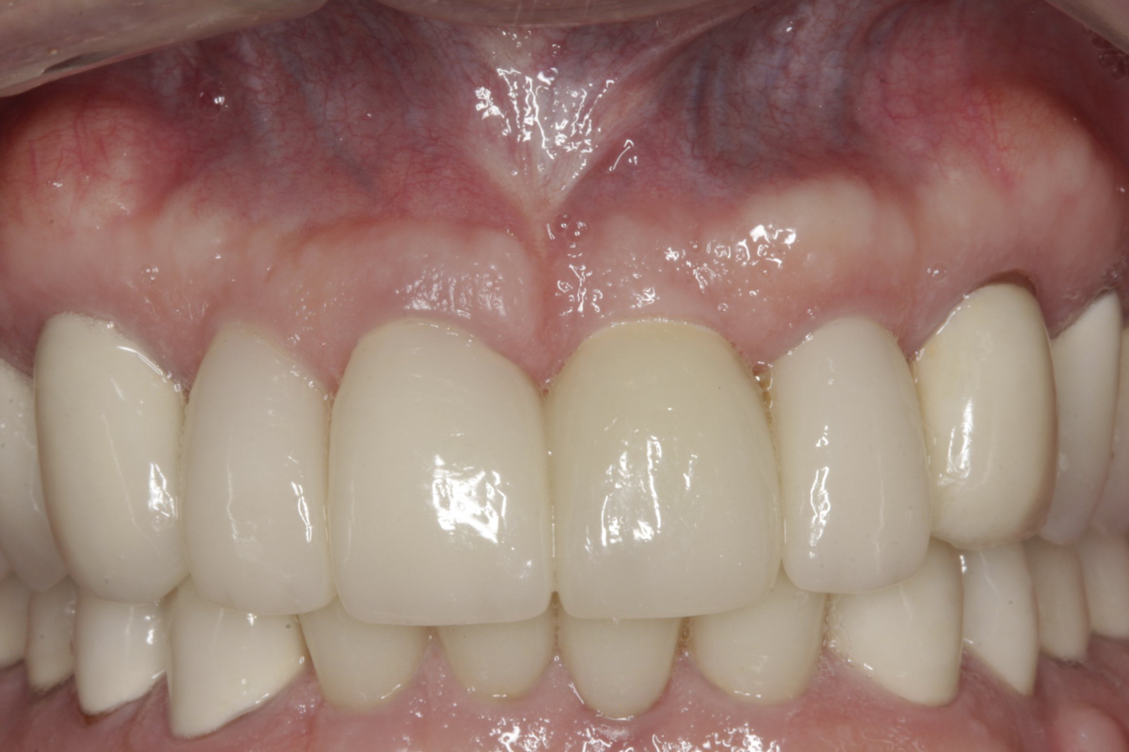 Dental Implants case study