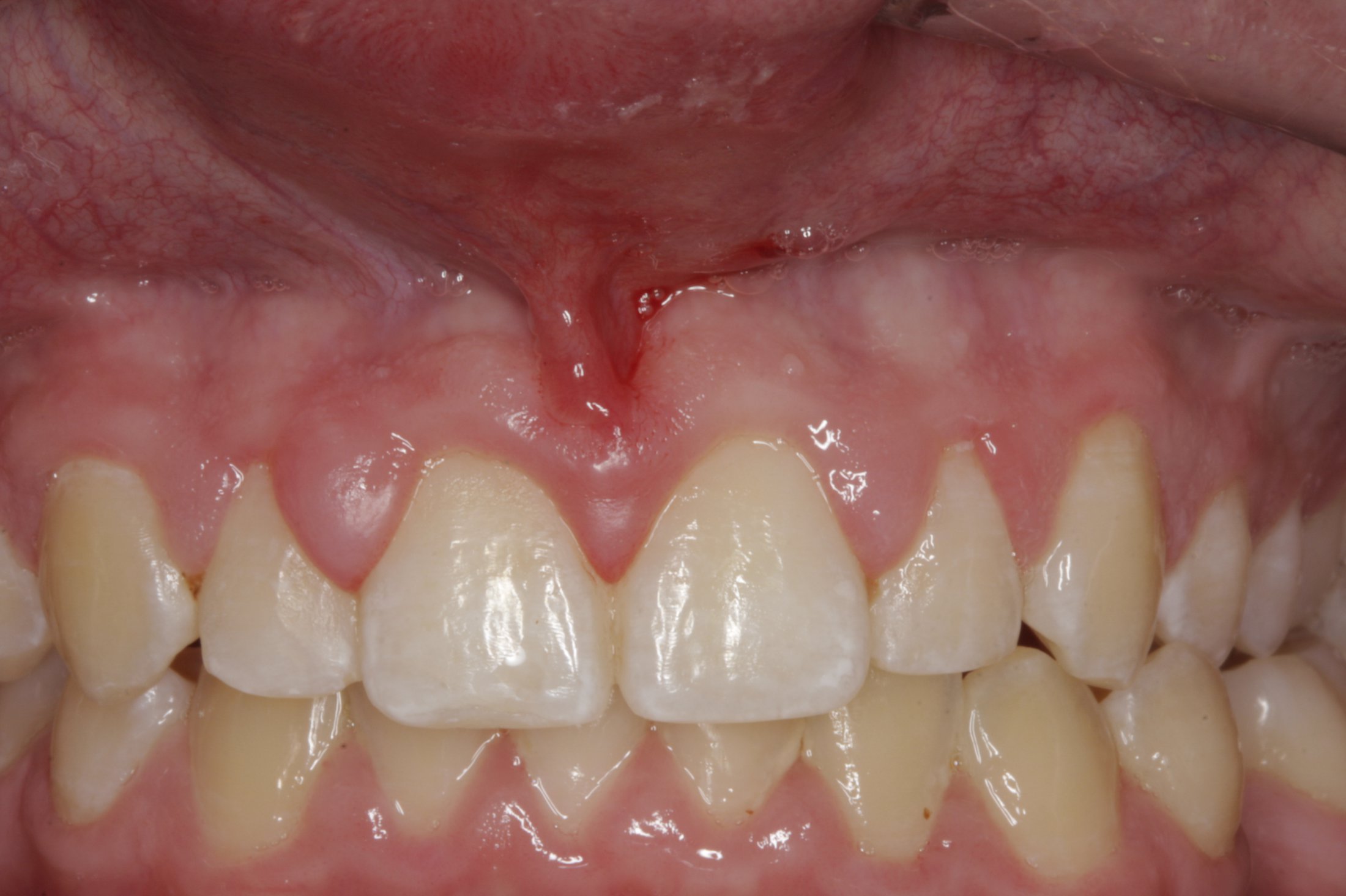 Esthetic Crown Lengthening case study