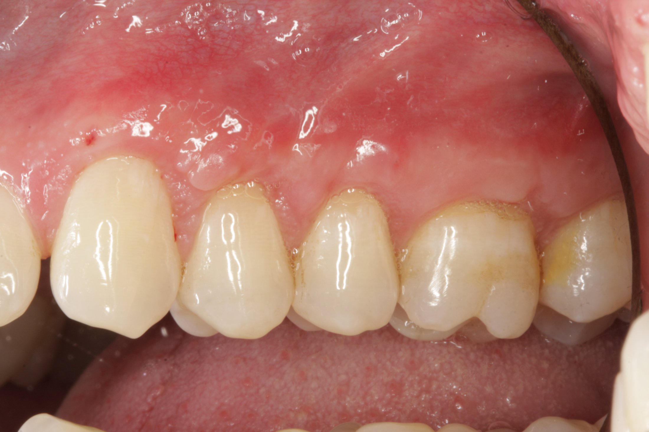 Allograft case study