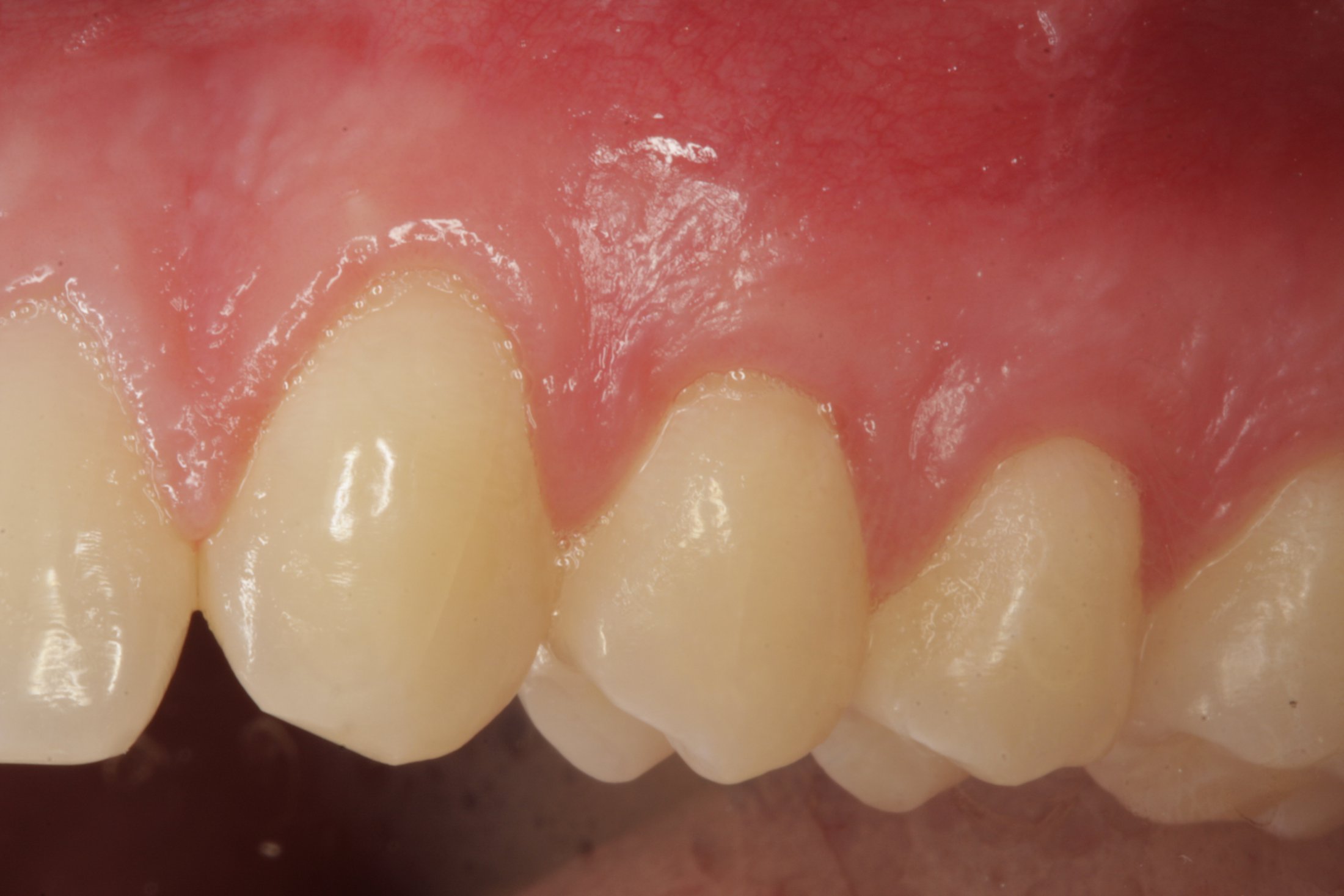 Connective Tissue Graft case study