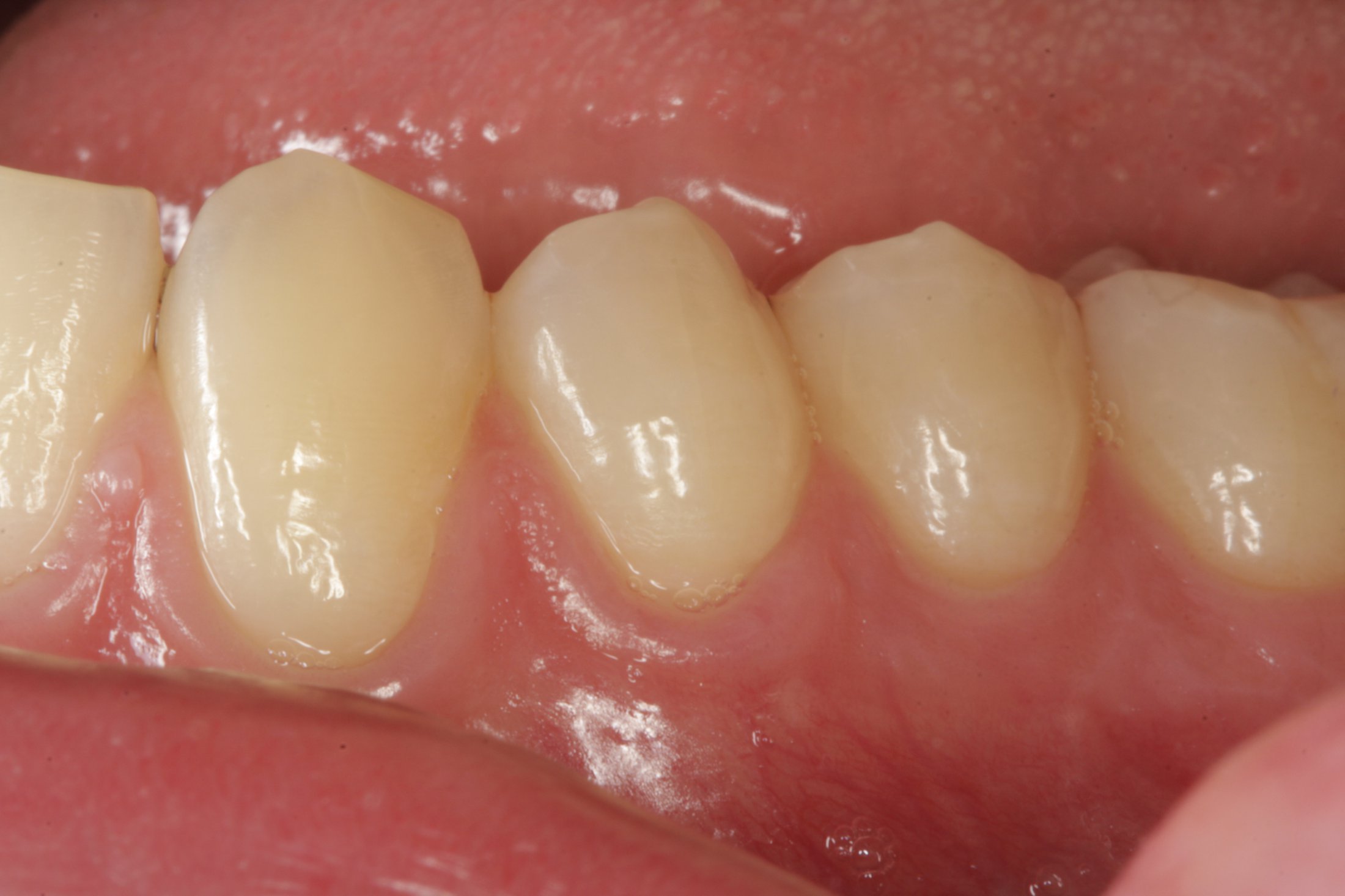 Connective Tissue Graft case study